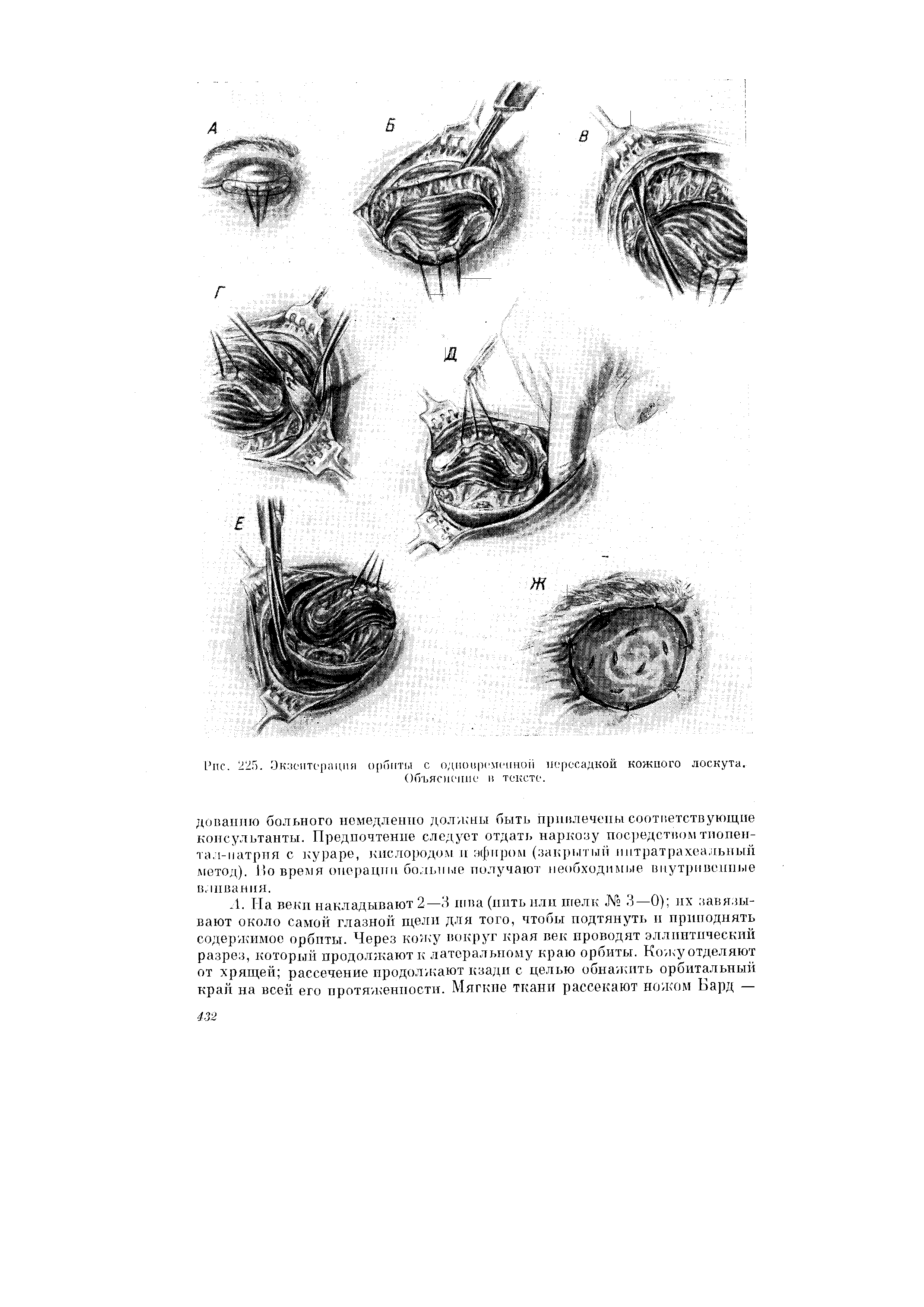 Рис. 225. Экзентерация орбиты с одновременной пересадкой кожного лоскута. Объяснение в тексте.