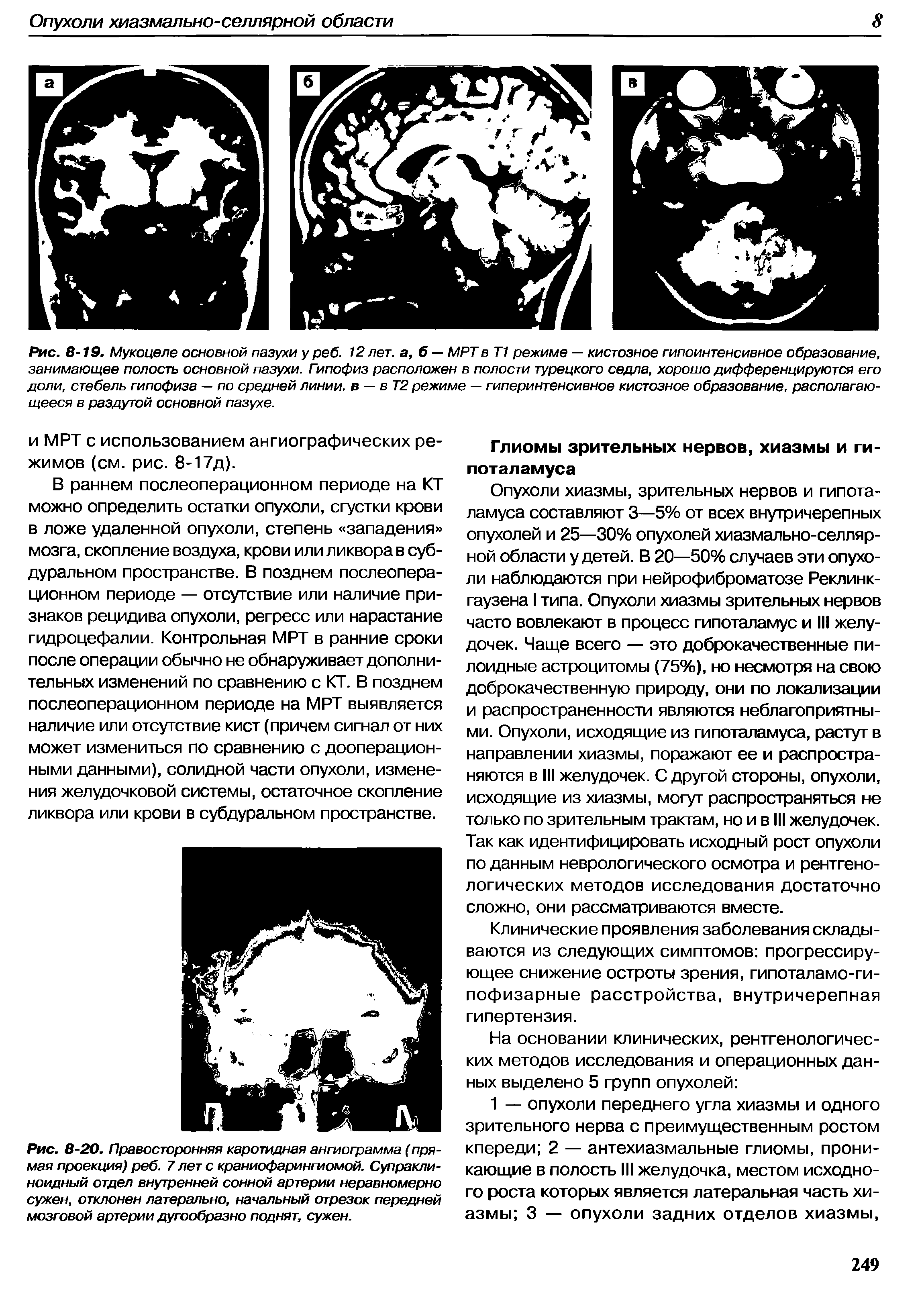 Рис. 8-20. Правосторонняя каротидная ангиограмма (прямая проекция) реб. 7 лет с краниофарингиомой. Супраклиноидный отдел внутренней сонной артерии неравномерно сужен, отклонен латерально, начальный отрезок передней мозговой артерии дугообразно поднят, сужен.