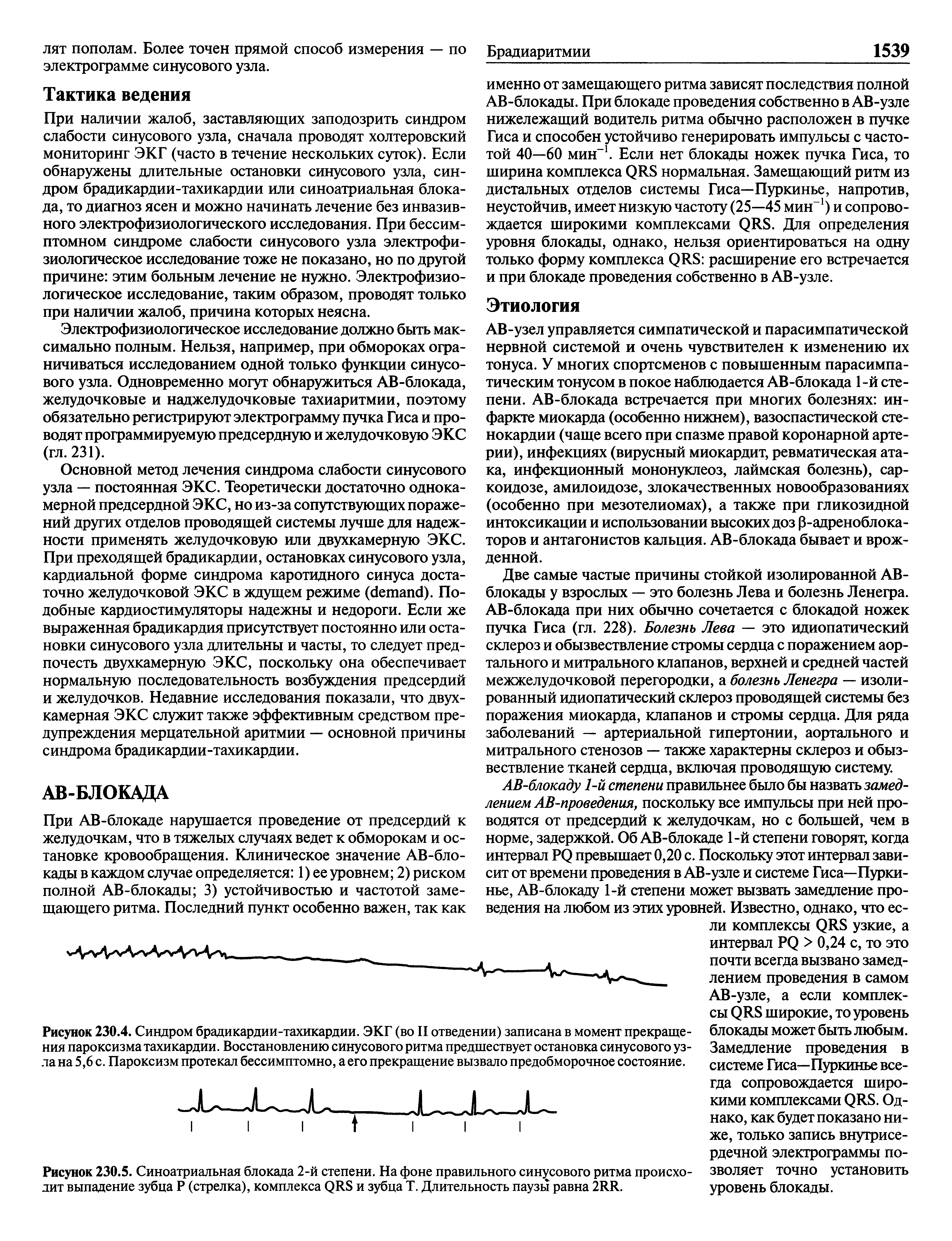 Рисунок 230.4. Синдром брадикардии-тахикардии. ЭКГ (во II отведении) записана в момент прекращения пароксизма тахикардии. Восстановлению синусового ритма предшествует остановка синусового узла на 5,6 с. Пароксизм протекал бессимптомно, а его прекращение вызвало предобморочное состояние.