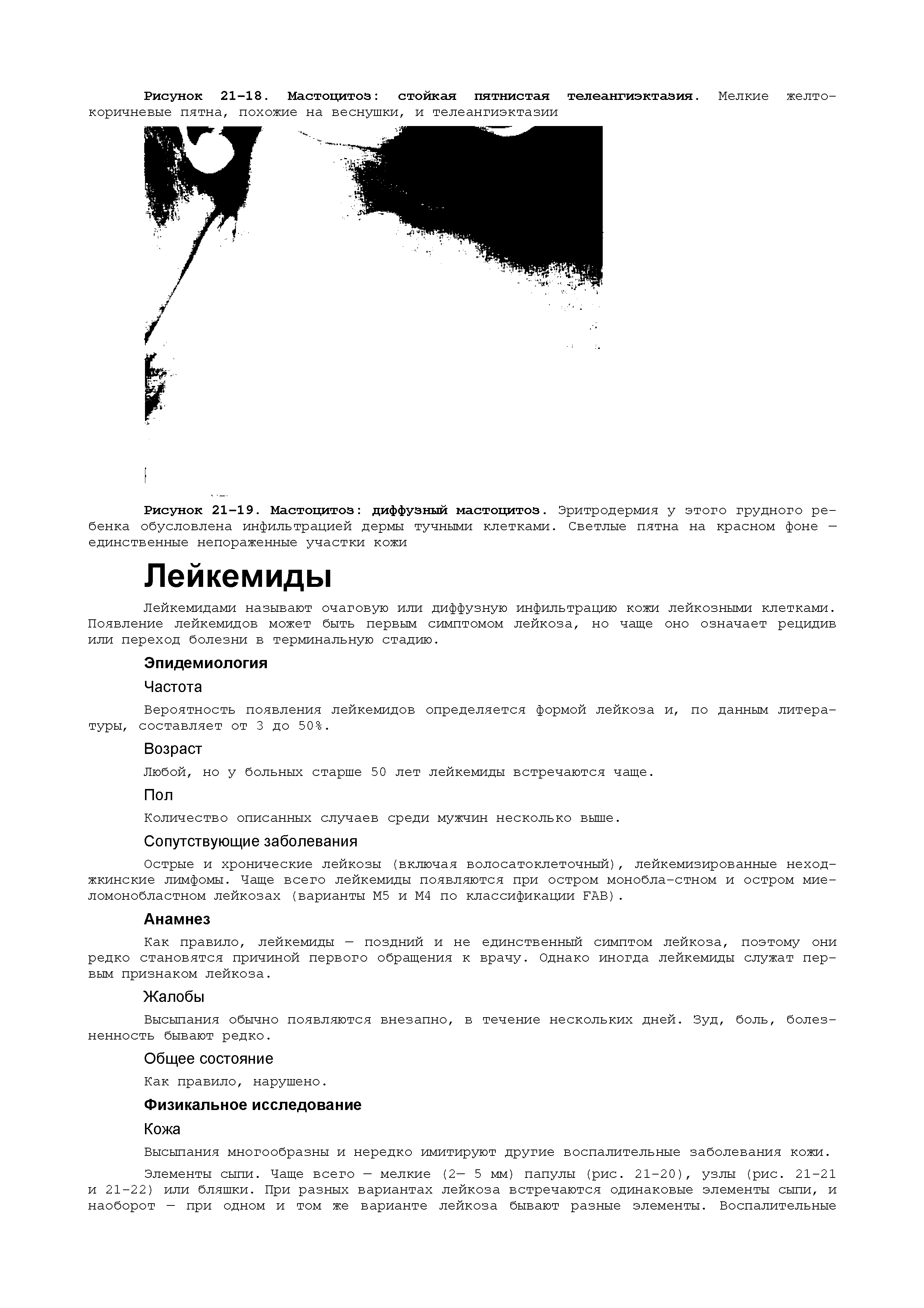 Рисунок 21-19. Мастоцитоз диффузный мастоцитоз. Эритродермия у этого грудного ребенка обусловлена инфильтрацией дермы тучными клетками. Светлые пятна на красном фоне — единственные непораженные участки кожи...