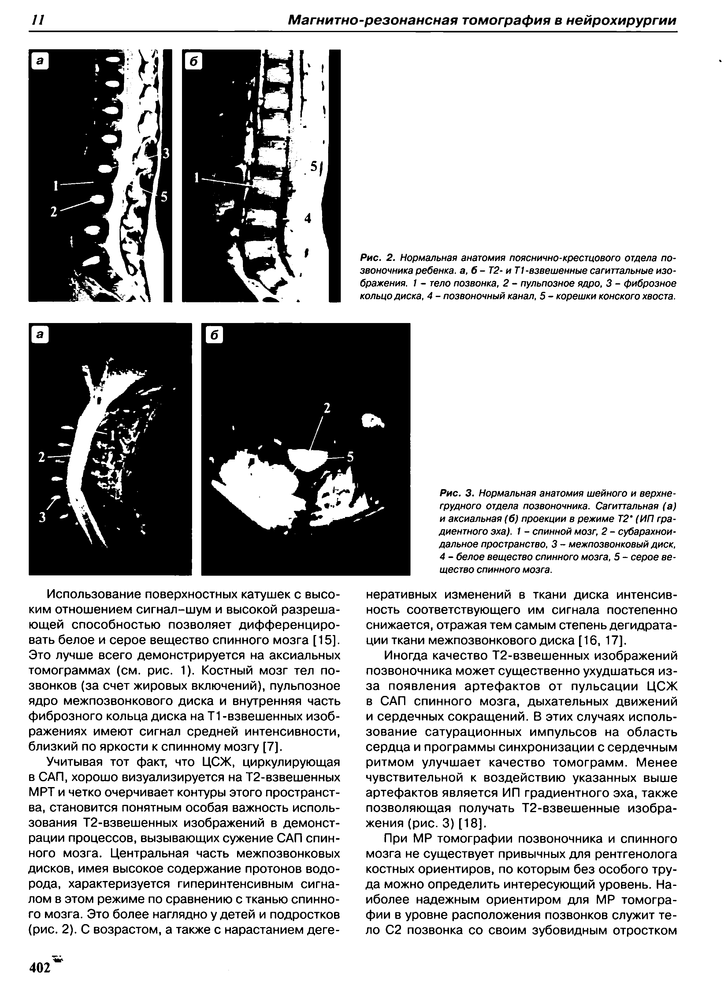 Рис. 3. Нормальная анатомия шейного и верхнегрудного отдела позвоночника. Сагиттальная (а) и аксиальная (б) проекции в режиме Т2 (ИП градиентного эха). 1 - спинной мозг, 2 - субарахноидальное пространство, 3 - межпозвонковый диск, 4 - белое вещество спинного мозга, 5 - серое вещество спинного мозга.