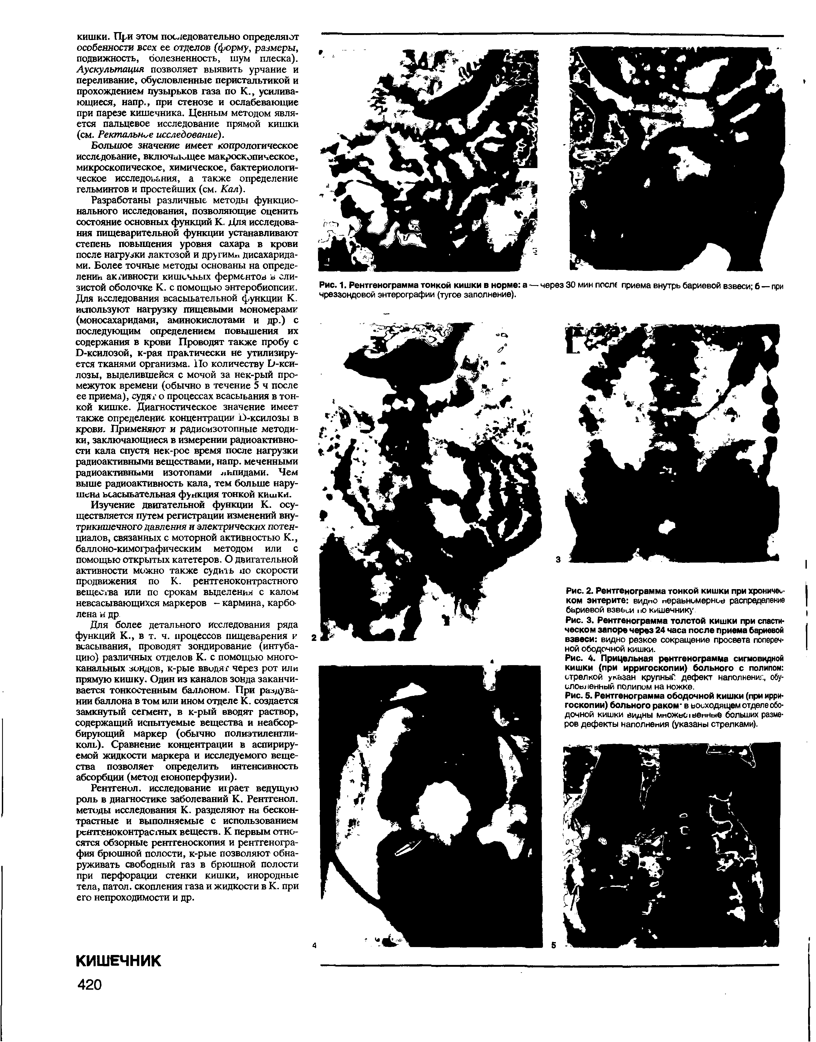 Рис. 3. Рентгенограмма толстой кишки при спастическом запоре через 24 часа после приема бариевой взвеси видно резкое сокращение просвета поперечной ободочной кишки.