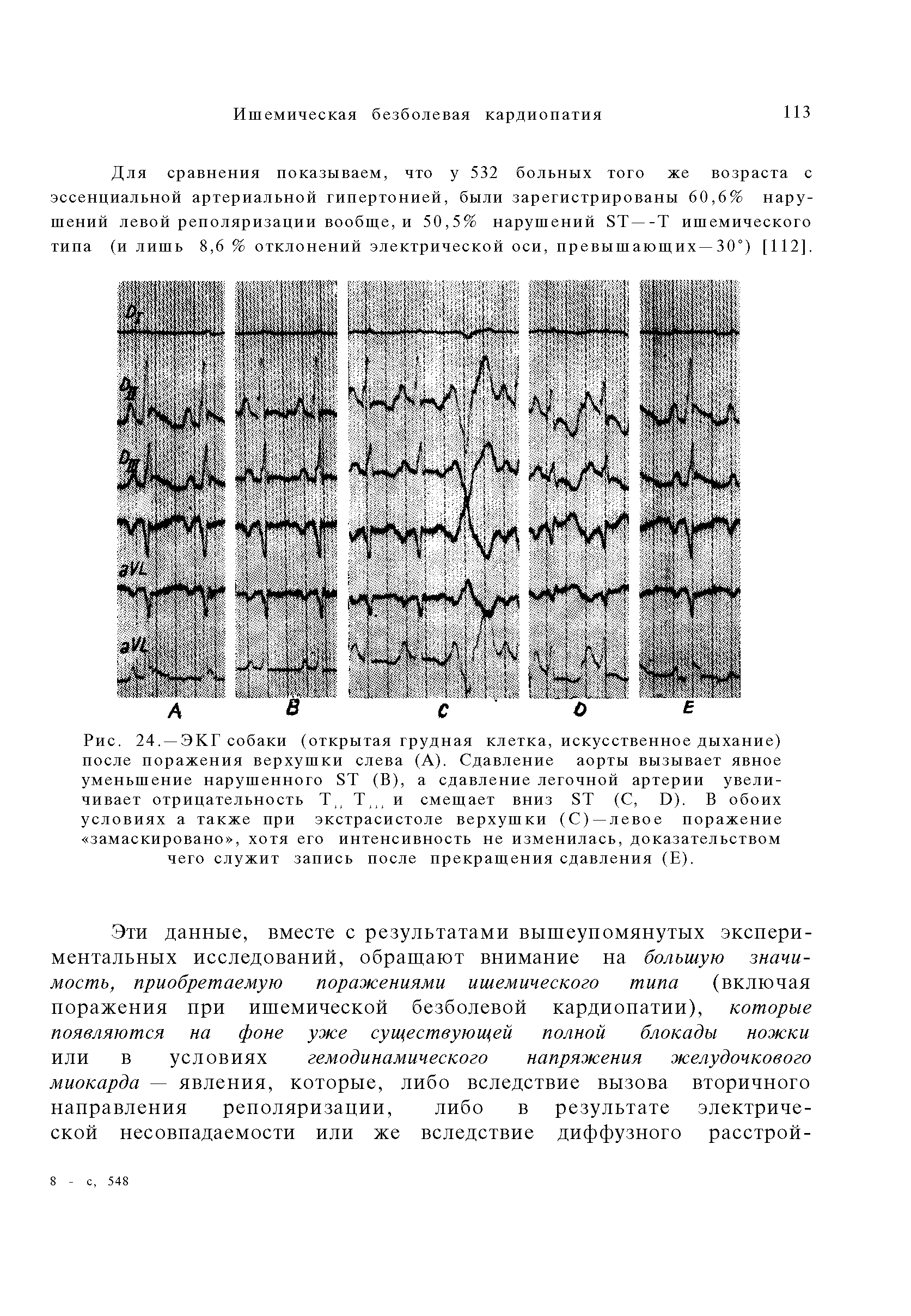 Рис. 24. —ЭКГ собаки (открытая грудная клетка, искусственное дыхание) после поражения верхушки слева (А). Сдавление аорты вызывает явное уменьшение нарушенного 8Т (В), а сдавление легочной артерии увеличивает отрицательность Т, Т , и смещает вниз 8Т (С, Э). В обоих...