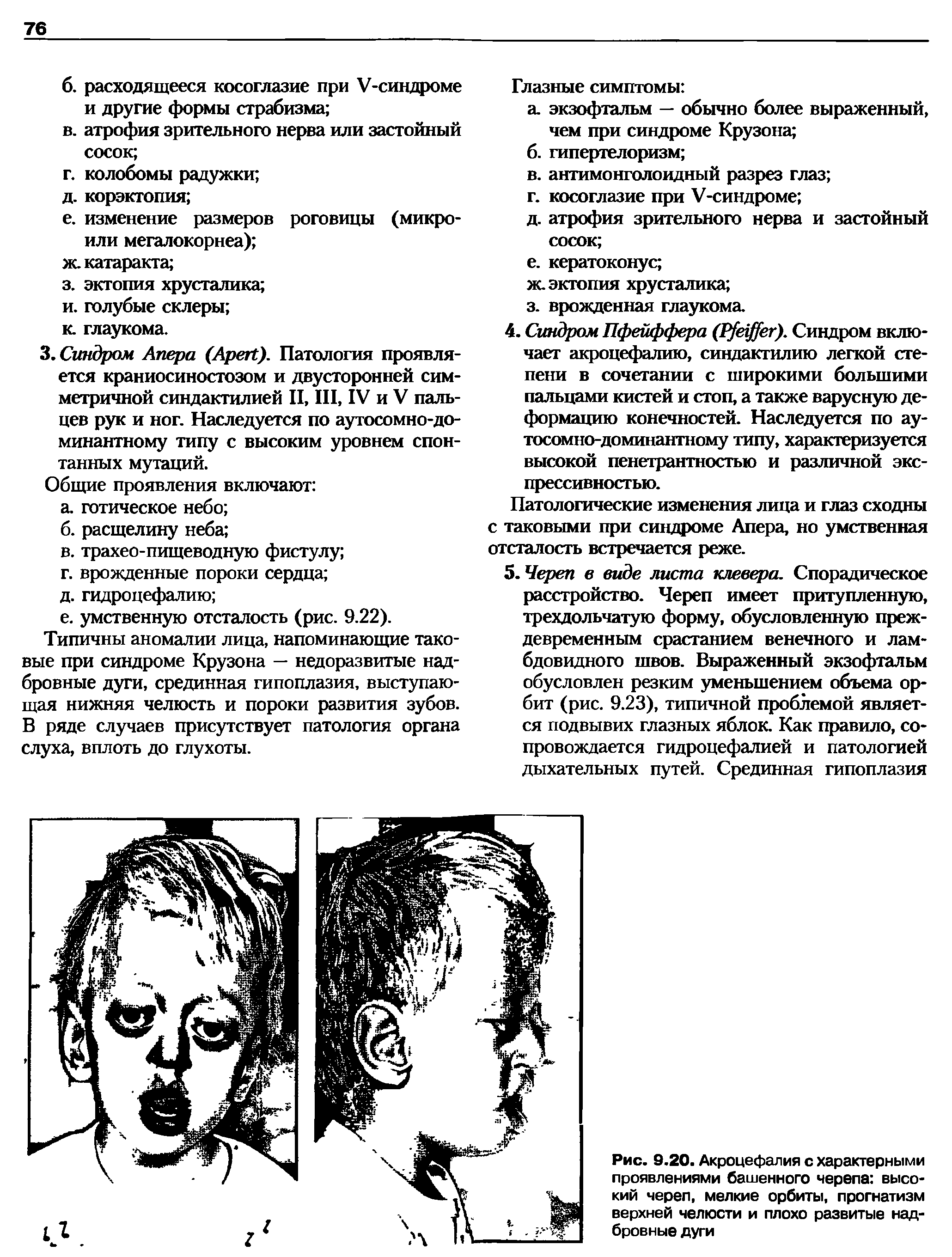 Рис. 9.20. Акроцефалия с характерными проявлениями башенного черепа высокий череп, мелкие орбиты, прогнатизм верхней челюсти и плохо развитые надбровные дуги...