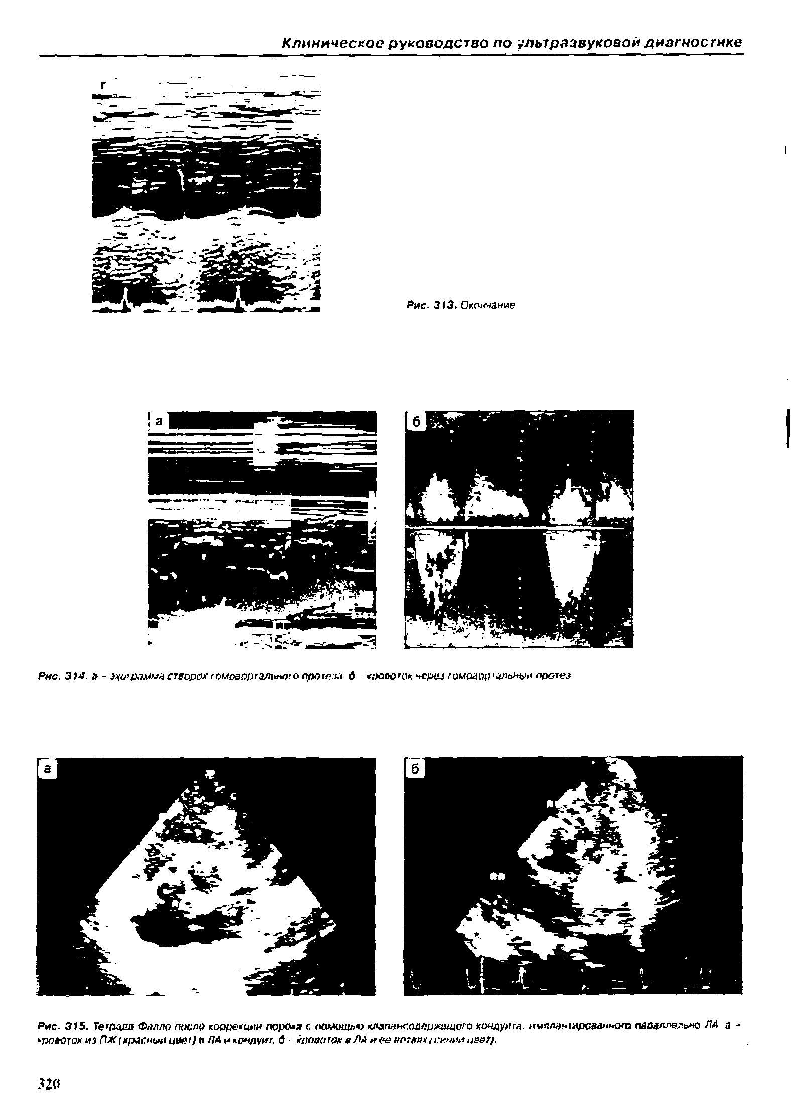 Рис. 315. Гетида Фалло поело коррекции порока с памешдо клапакодержощото кондуита нчллач1ироеанмхо параллельно ЛА а - поаогокиз ЛХ(мрасны иН19г п /74 и о ЛУ ". б - кровоток ЛА иеенотвттсишычввт/.