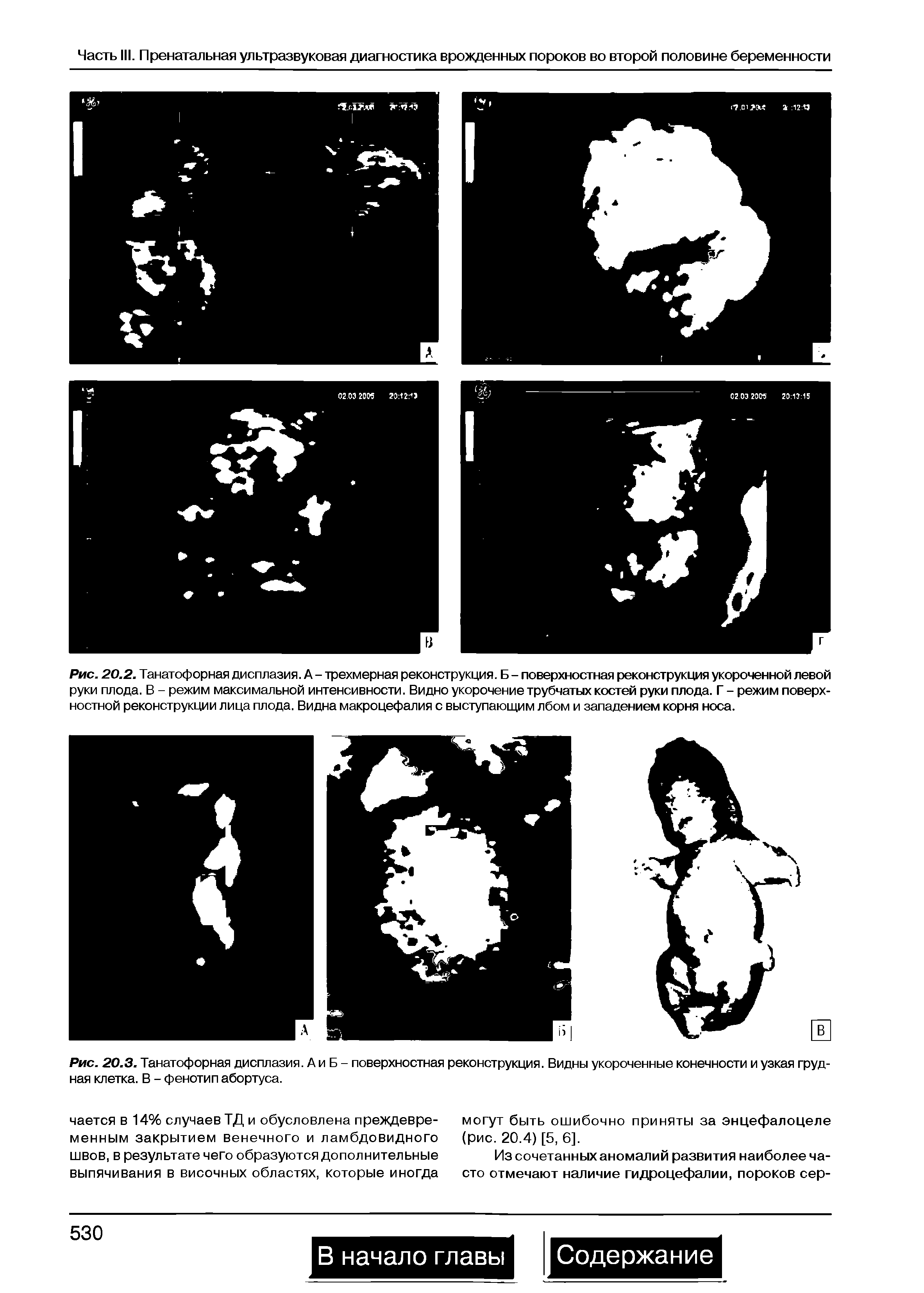 Рис. 20.2. Танатофорная дисплазия. А - трехмерная реконструкция. Б - поверхностная реконструкция укороченной левой руки плода. В - режим максимальной интенсивности. Видно укорочение трубчатых костей руки плода. Г - режим поверхностной реконструкции лица плода. Видна макроцефалия с выступающим лбом и западением корня носа.