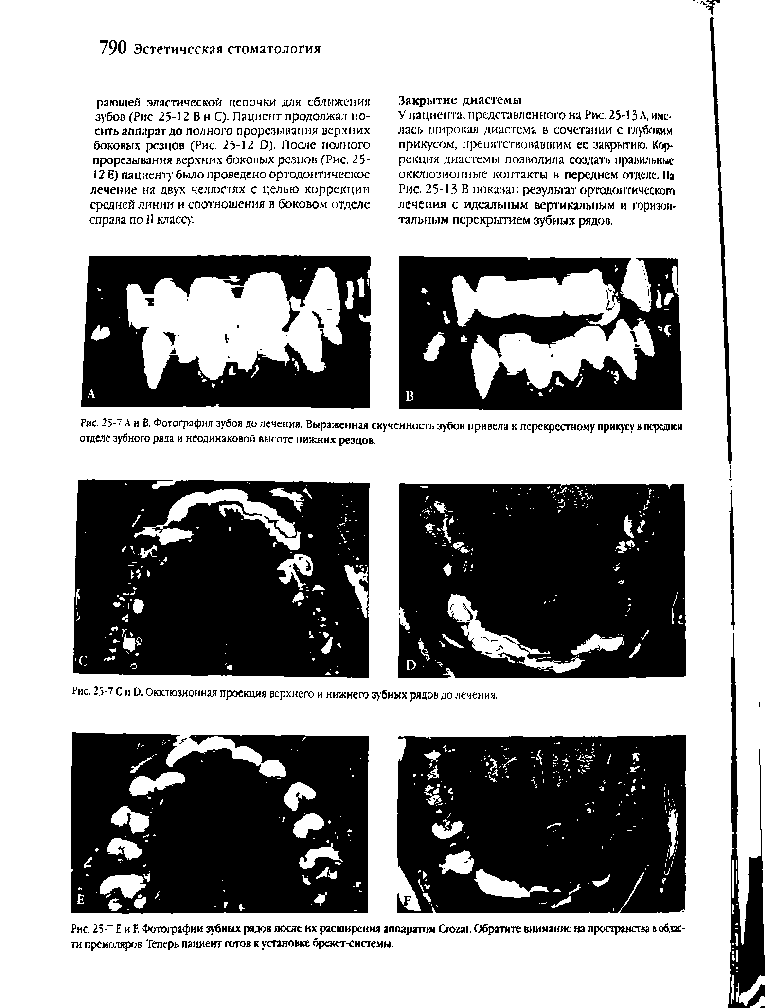 Рис. 25- Е и Е Фотографии зубных рядов посте их расширения аппаратом Сгогат Обратите внимание на пространства в области премоляров Теперь пациент готов к установке брскет-системы.