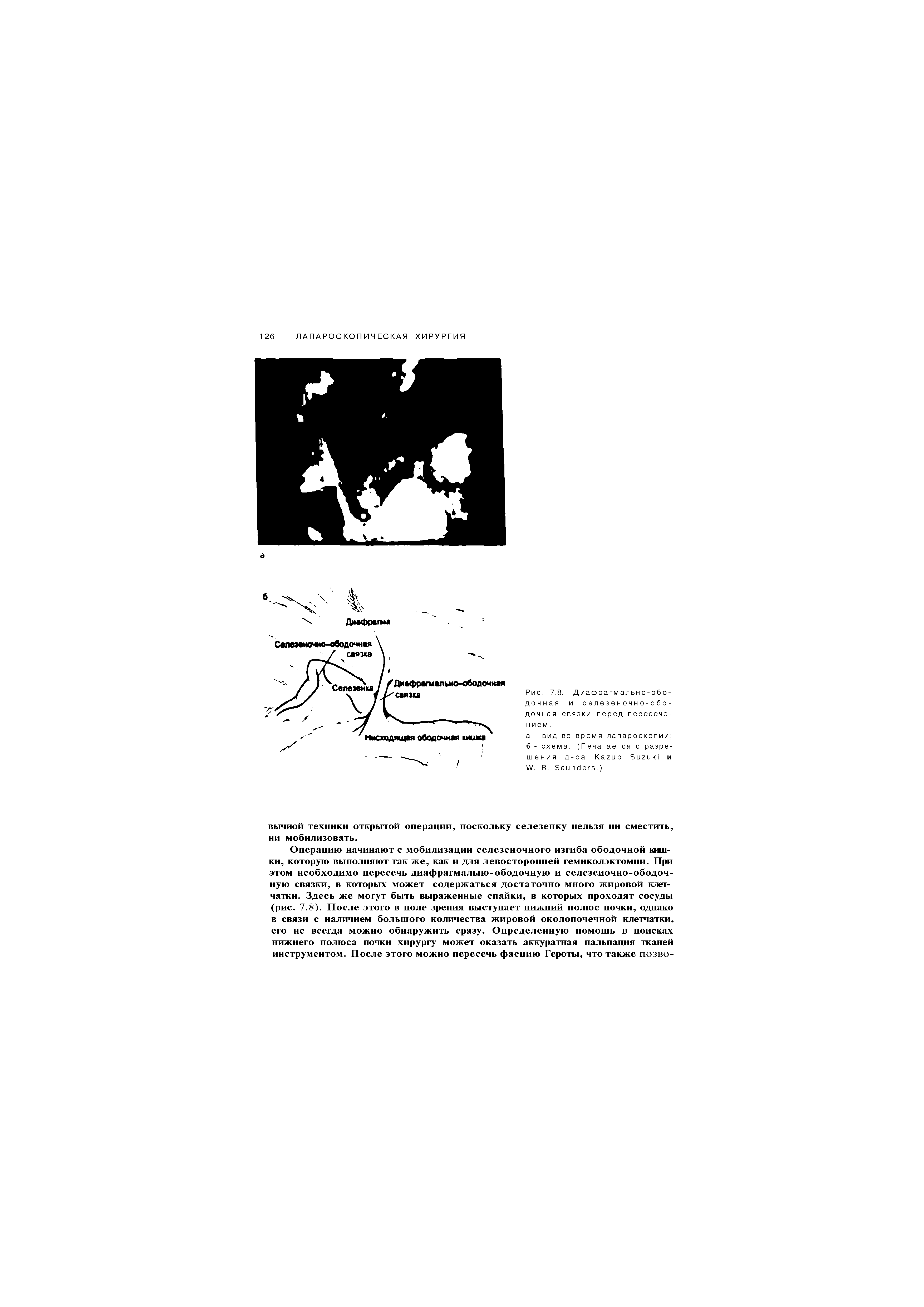 Рис. 7.8. Диафрагмально-ободочная и с е л е з е н о ч н о - о б о -дочная связки перед пересечением.