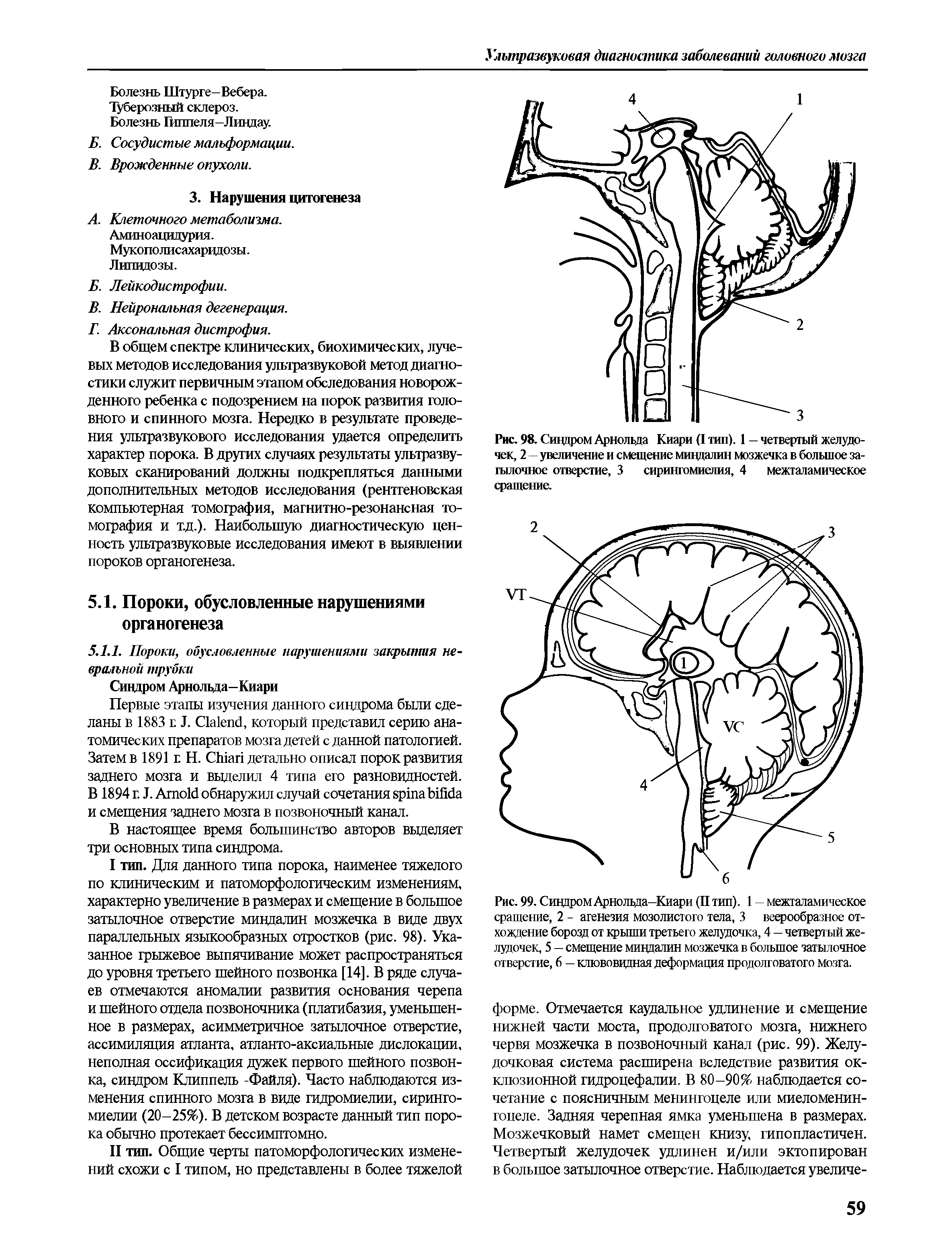 Рис. 98. Сивдром Арнольда Киари (I тип). 1 - четвертый желудочек, 2—увеличение и смещение мивдалин мозжечка в большое затылочное отверстие, 3 сирингомиелия, 4 межталамическое сращение.