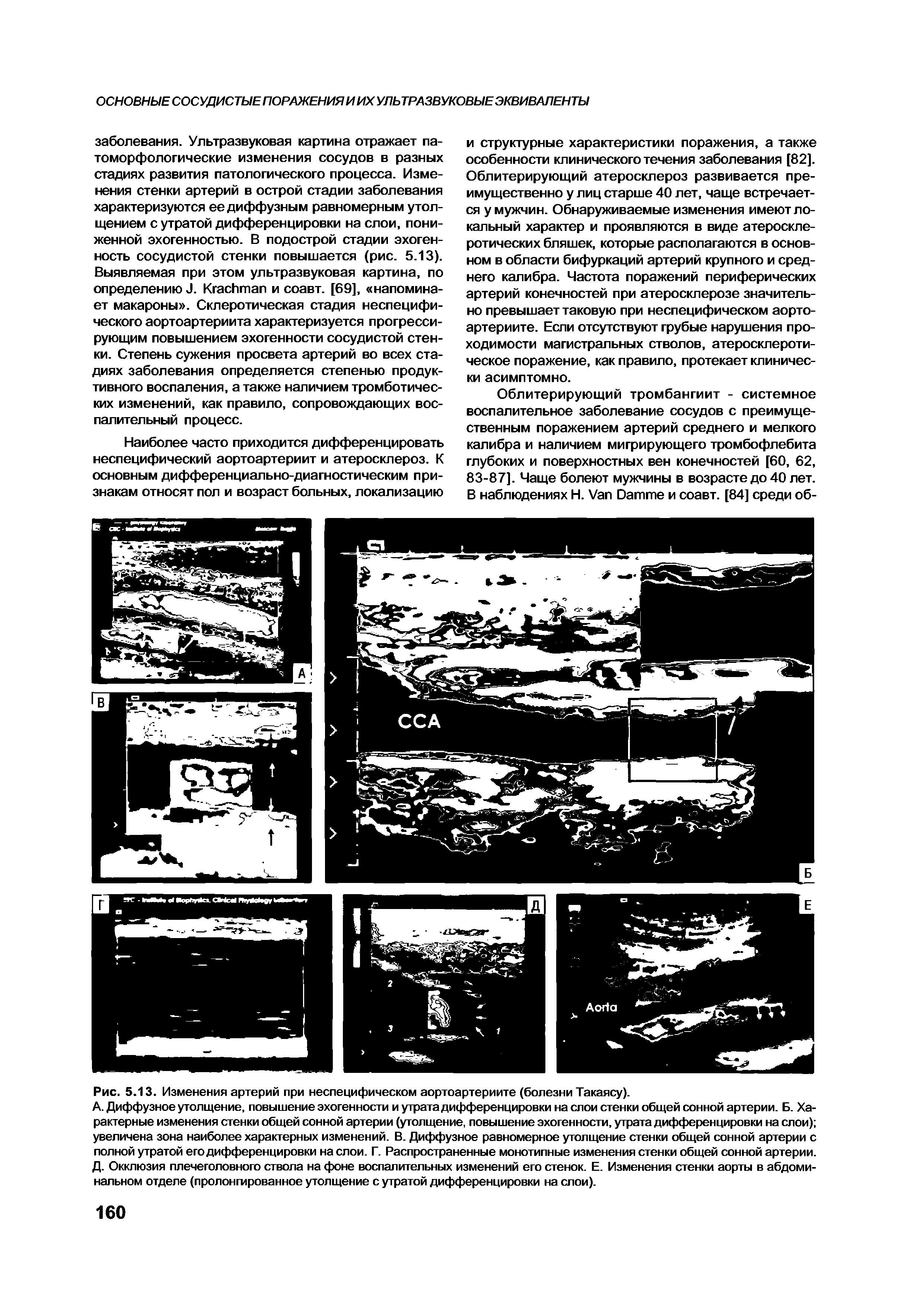 Рис. 5.13. Изменения артерий при неспецифическом аортоартериите (болезни Такаясу).