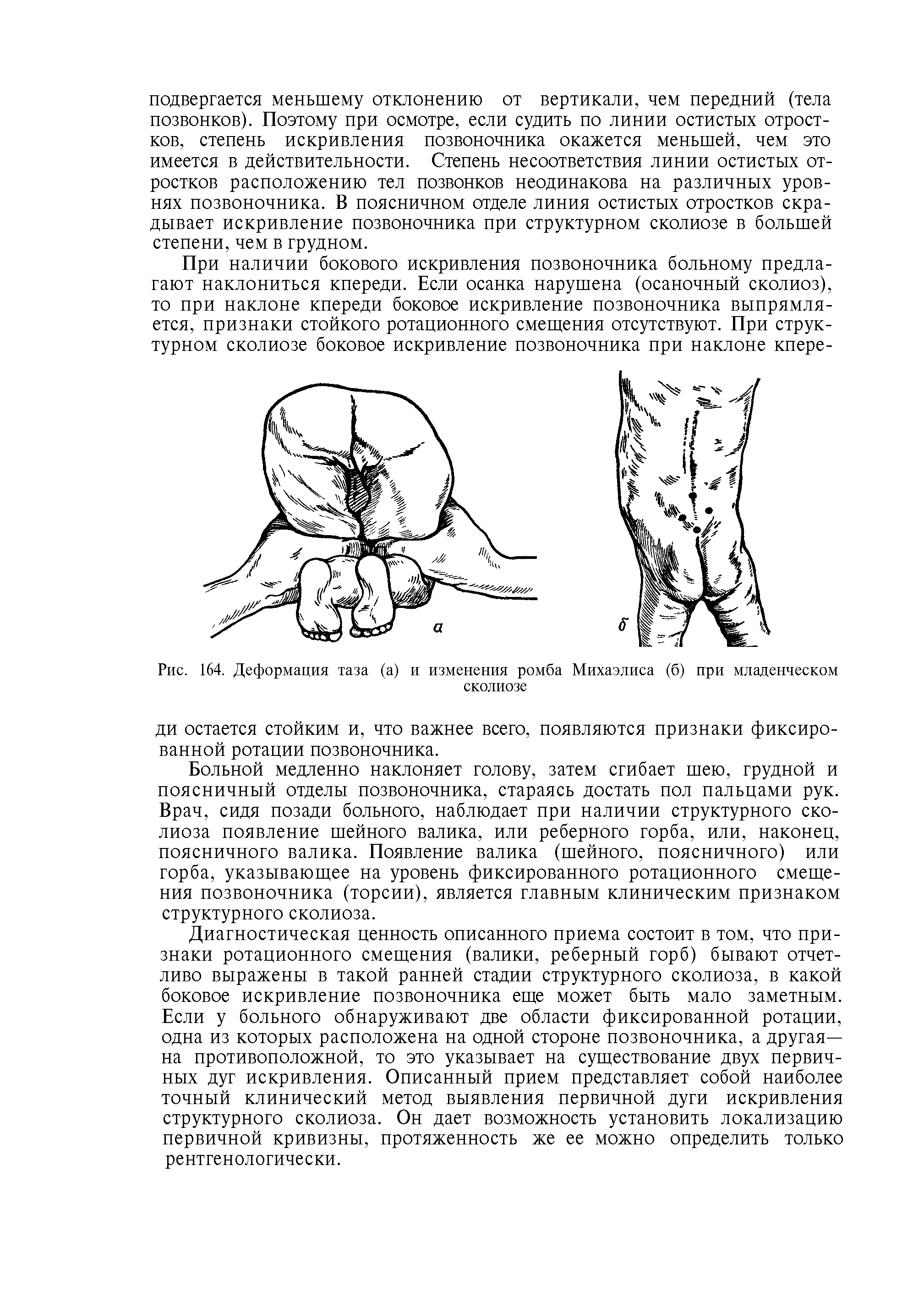 Рис. 164. Деформация таза (а) и изменения ромба Михаэлиса (б) при младенческом сколиозе...