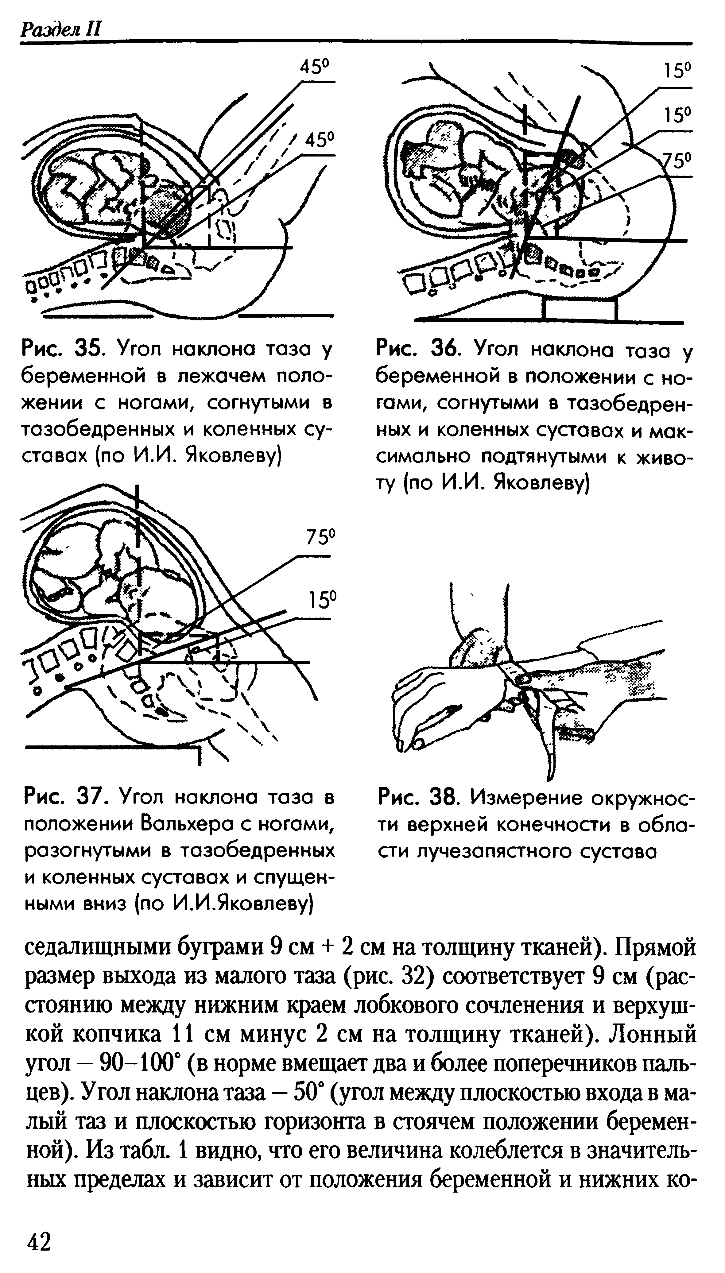 Рис. 35. Угол наклона таза у беременной в лежачем положении с ногами, согнутыми в тазобедренных и коленных суставах (по И.И. Яковлеву)...