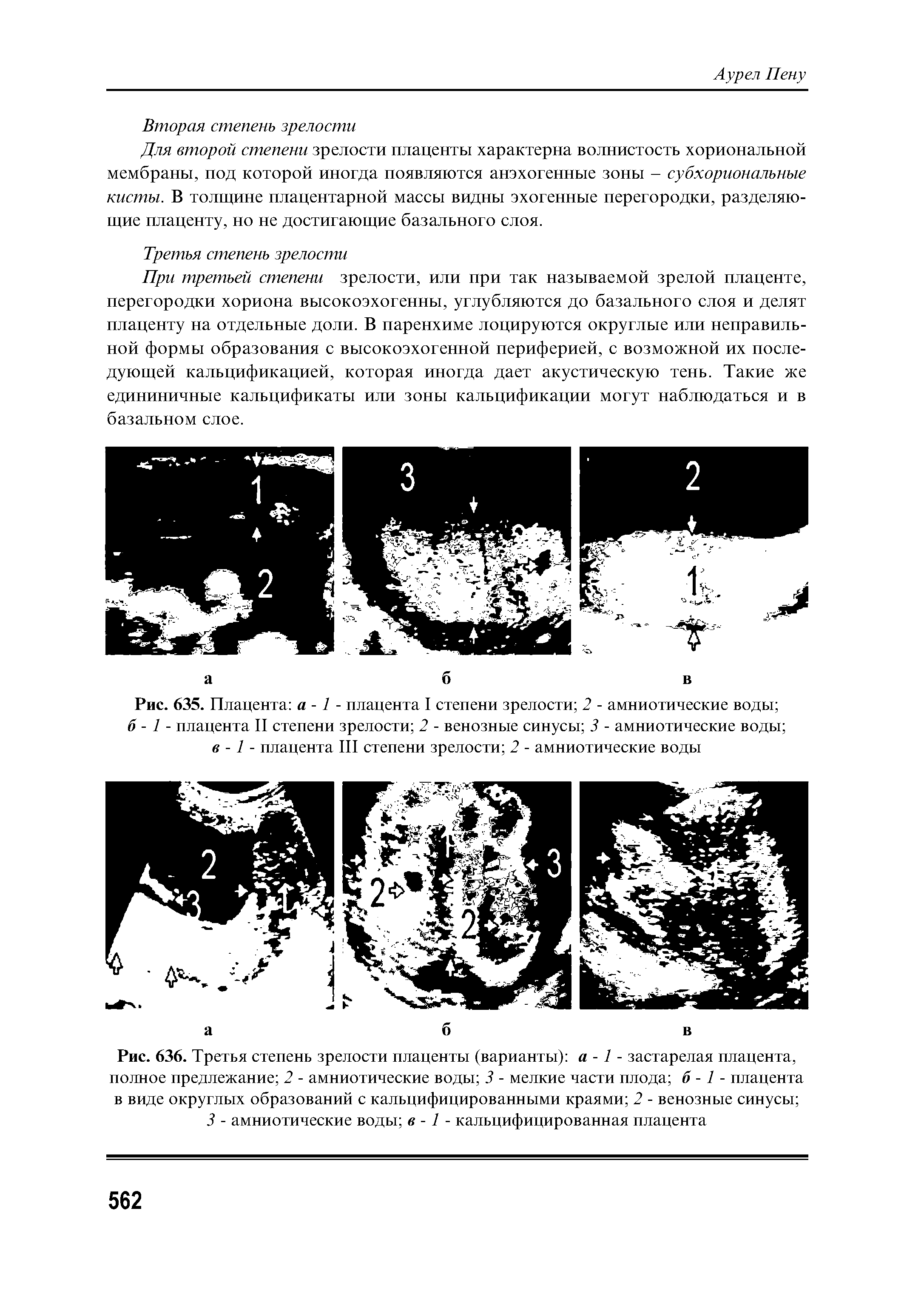 Рис. 636. Третья степень зрелости плаценты (варианты) а -1 - застарелая плацента, полное предлежание 2 - амниотические воды 3 - мелкие части плода б -1 - плацента в виде округлых образований с кальцифицированными краями 2 - венозные синусы ...