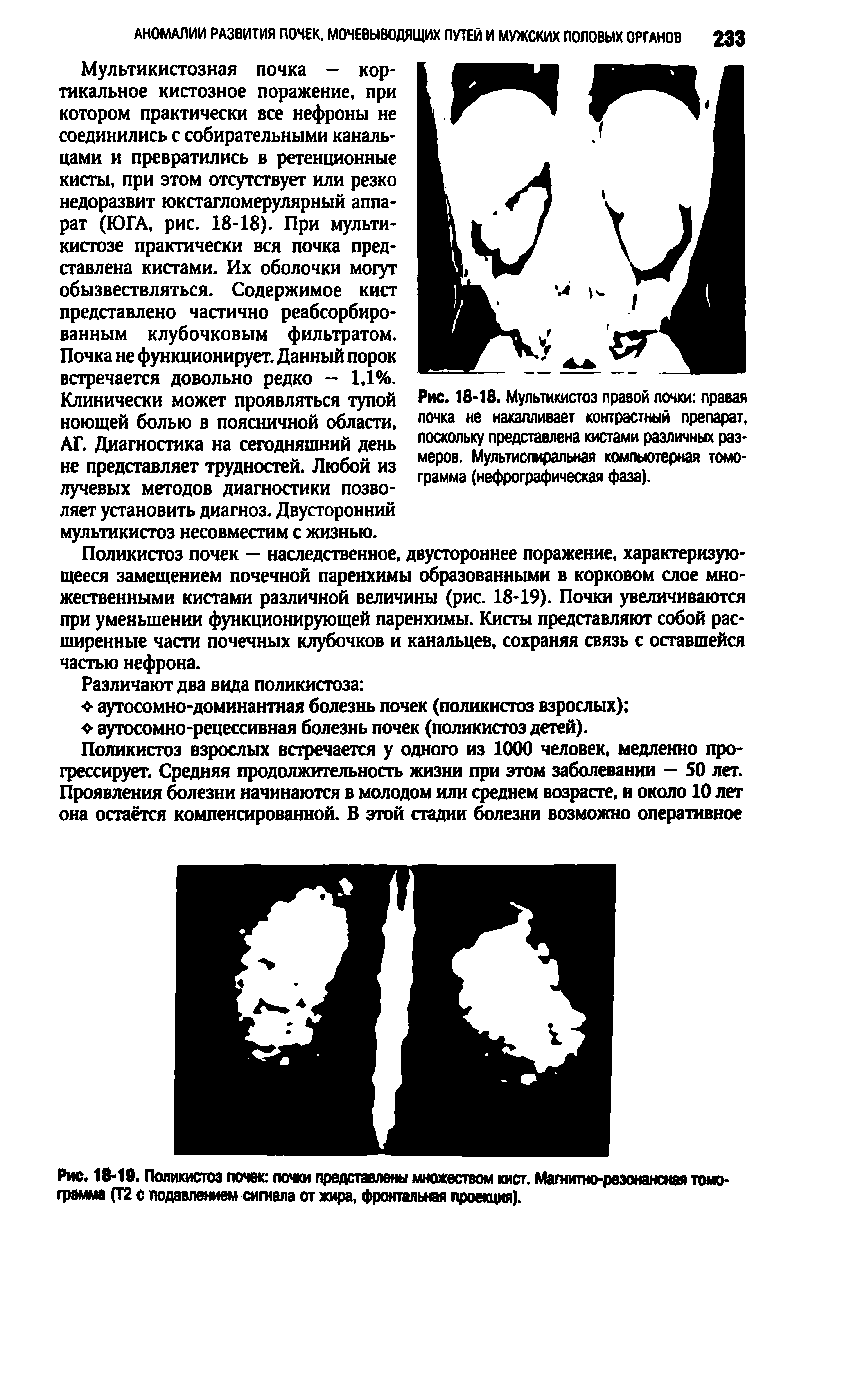 Рис. 18-18. Мультикистоз правой почки правая почка не накапливает контрастный препарат, поскольку представлена кистами различных размеров. Мультислиральная компьютерная томограмма (нефрографическая фаза).