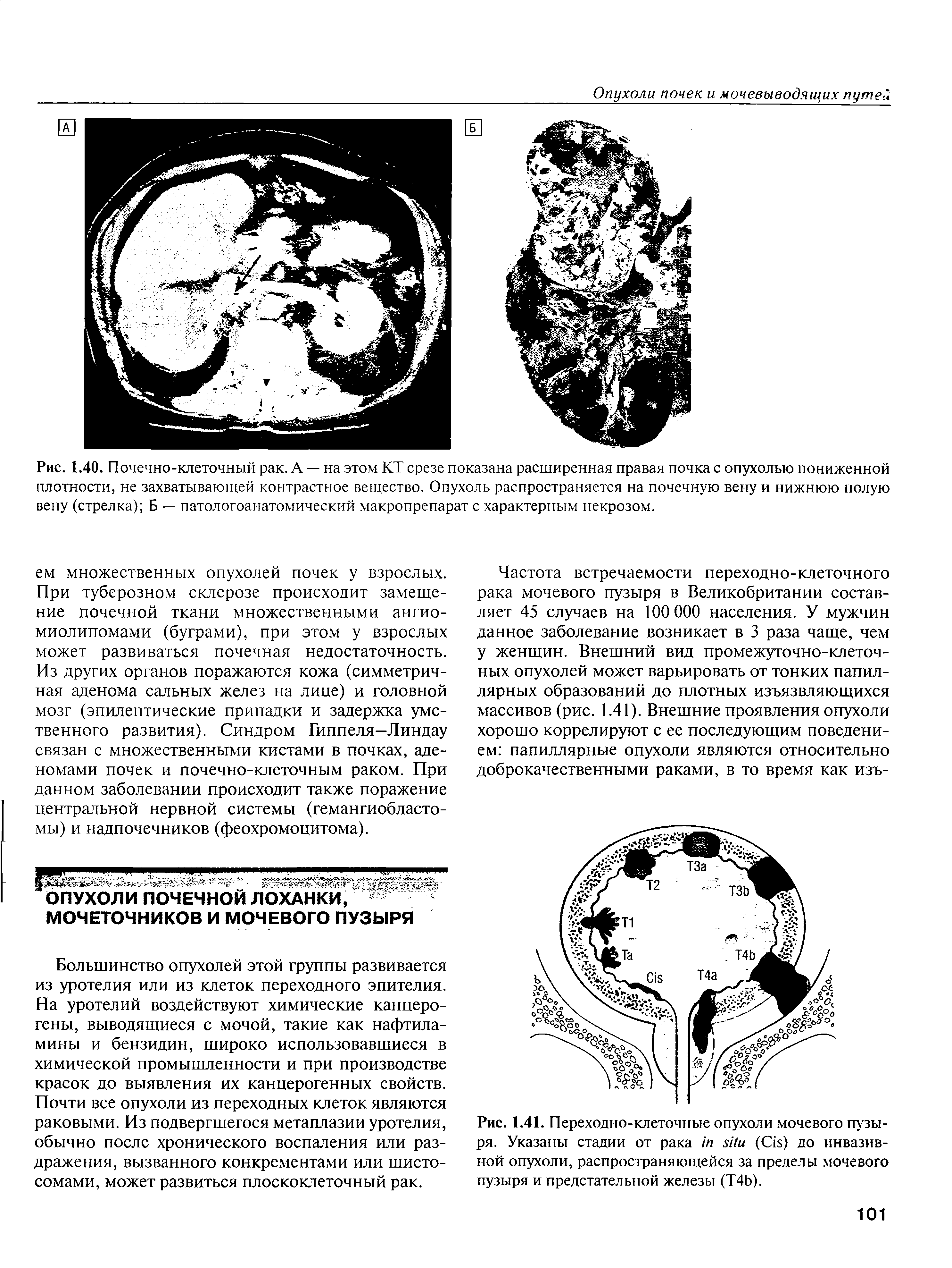 Рис. 1.41. Переходно-клеточные опухоли мочевого пузыря. Указаны стадии от рака (C ) до инвазивной опухоли, распространяющейся за пределы мочевого пузыря и предстательной железы (Т4Ь).