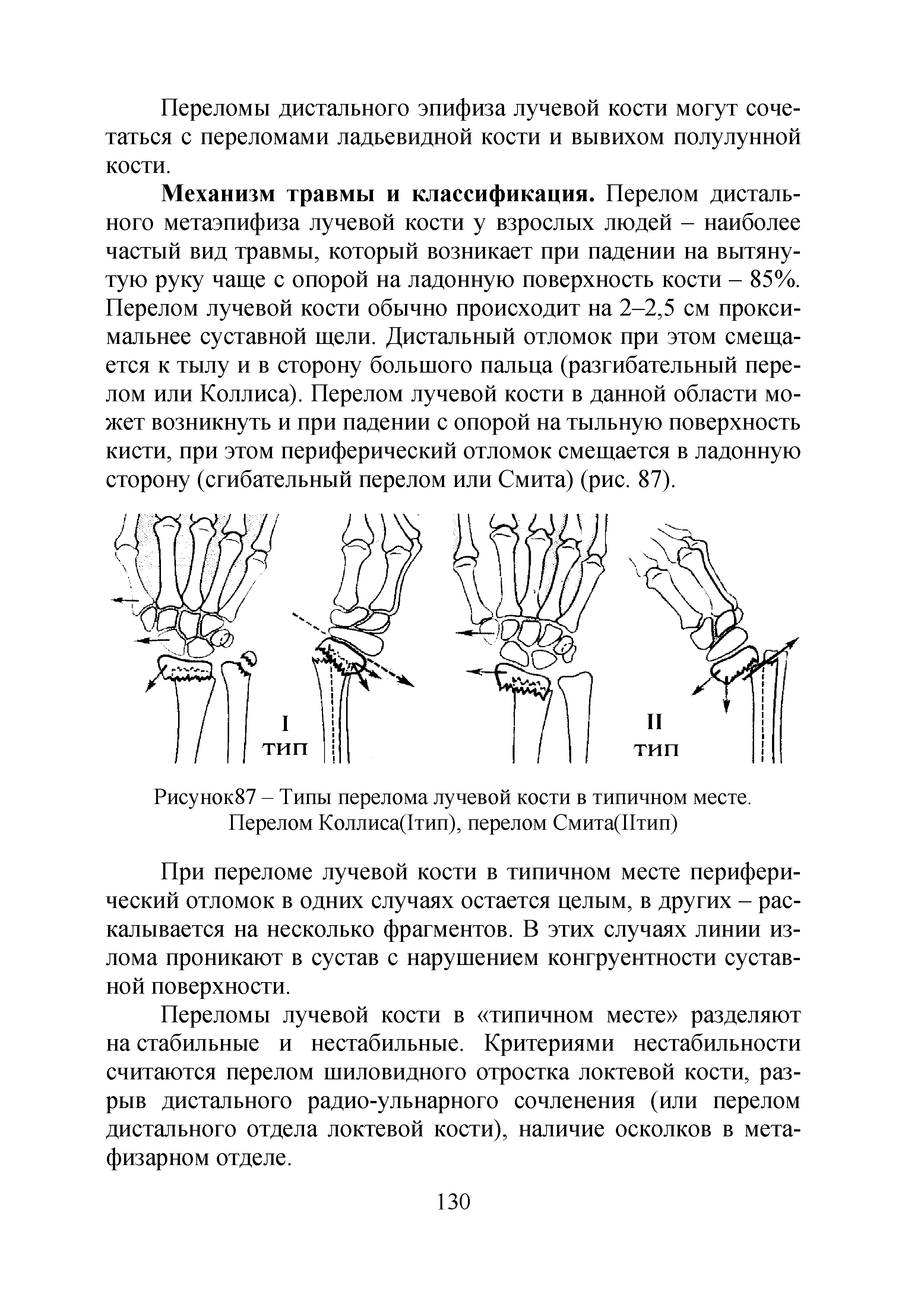 Рисунок87 - Типы перелома лучевой кости в типичном месте. Перелом Коллиса(1тип), перелом Смита(Птип)...