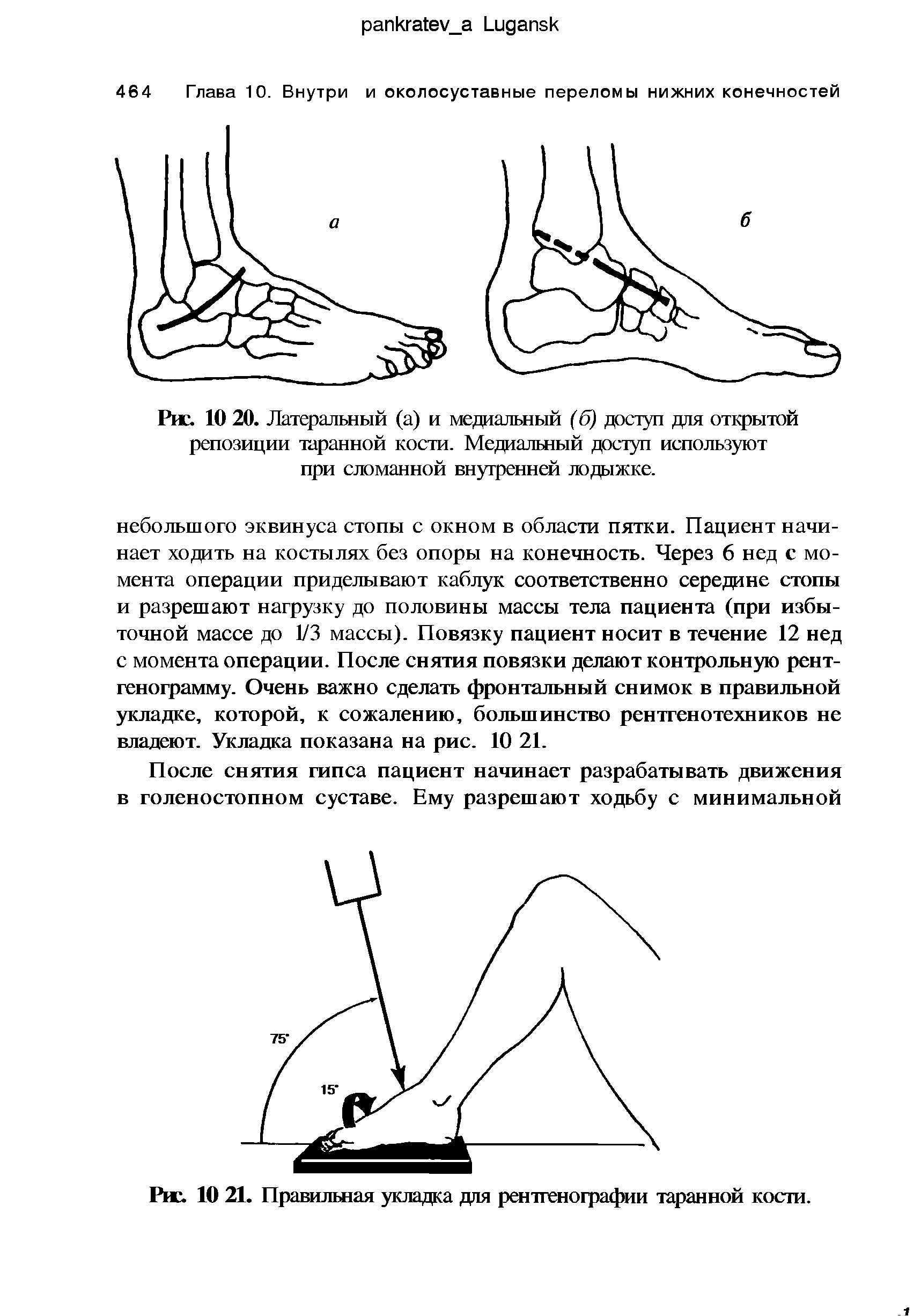 Рис. 10 20. Латеральный (а) и медиальный (б) доступ для открытой репозиции таранной кости. Медиальный доступ используют при сломанной внутренней лодыжке.