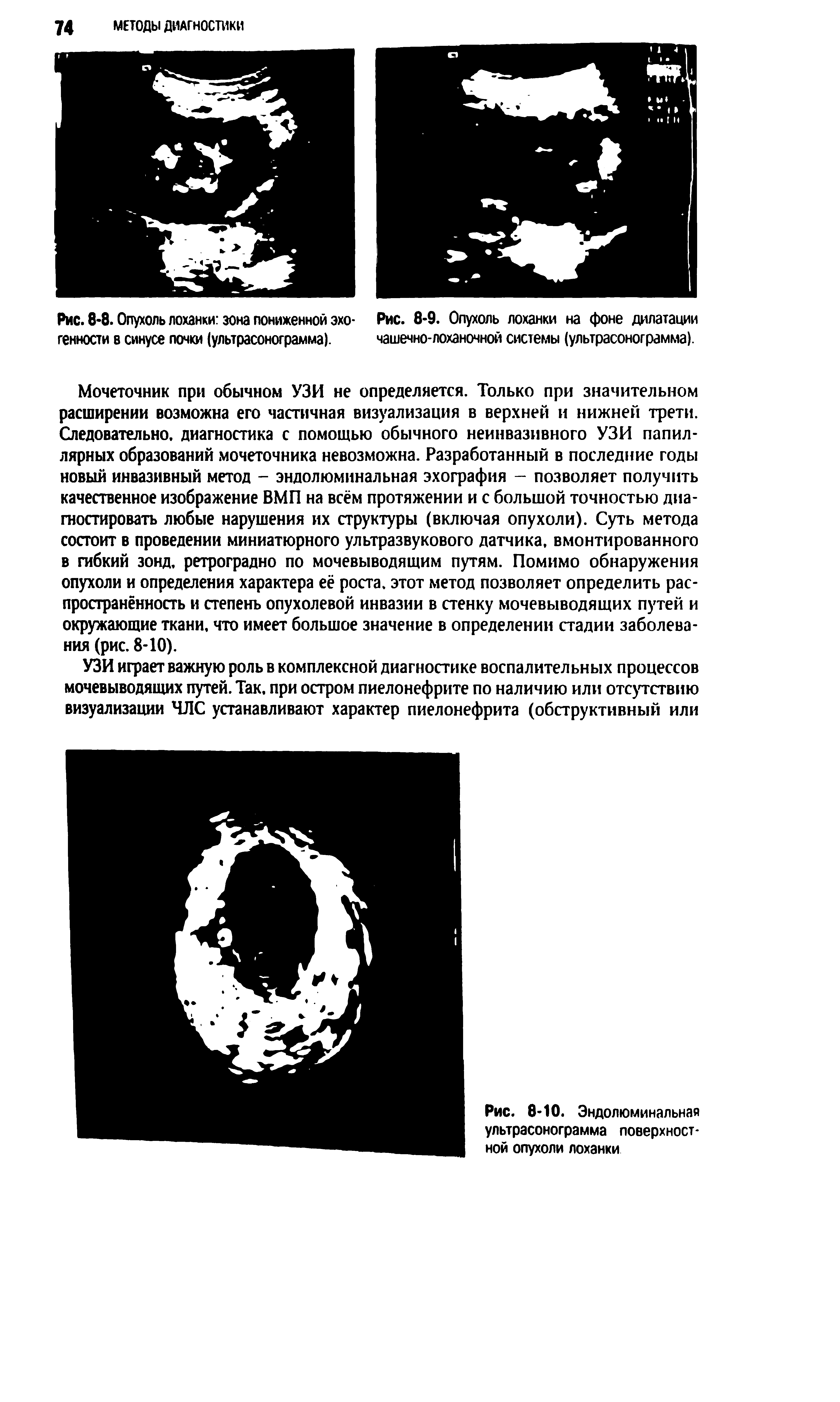 Рис. 8-8. Опухоль лоханки зона пониженной эхо- Рис. 8-9. Опухоль лоханки на фоне дилатации генности в синусе почки (ультрасонограмма). чашечно-лоханочной системы (ультрасонограмма).