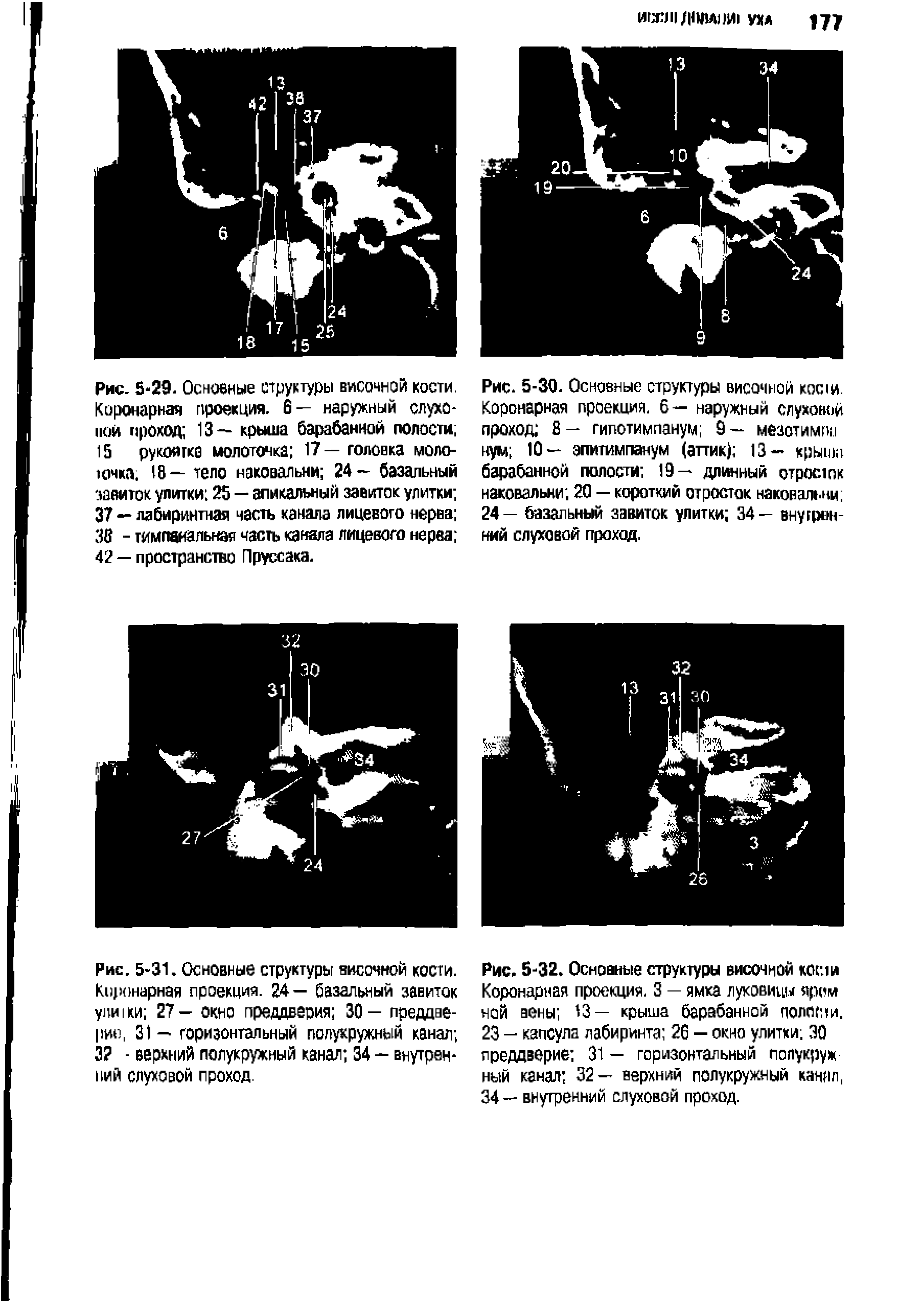 Рис. 5-30. Основные структуры височной кости. Коронарная проекция. 6— наружный слуховой проход 8- гипотимпанум 9— мезотимпи нум 10— эпитимпанум (аттик) 13- крыша барабанной полости 19— длинный отросток наковальни 20 — короткий отросток наковальни 24— базальный завиток улитки 34— внутренний слуховой проход.