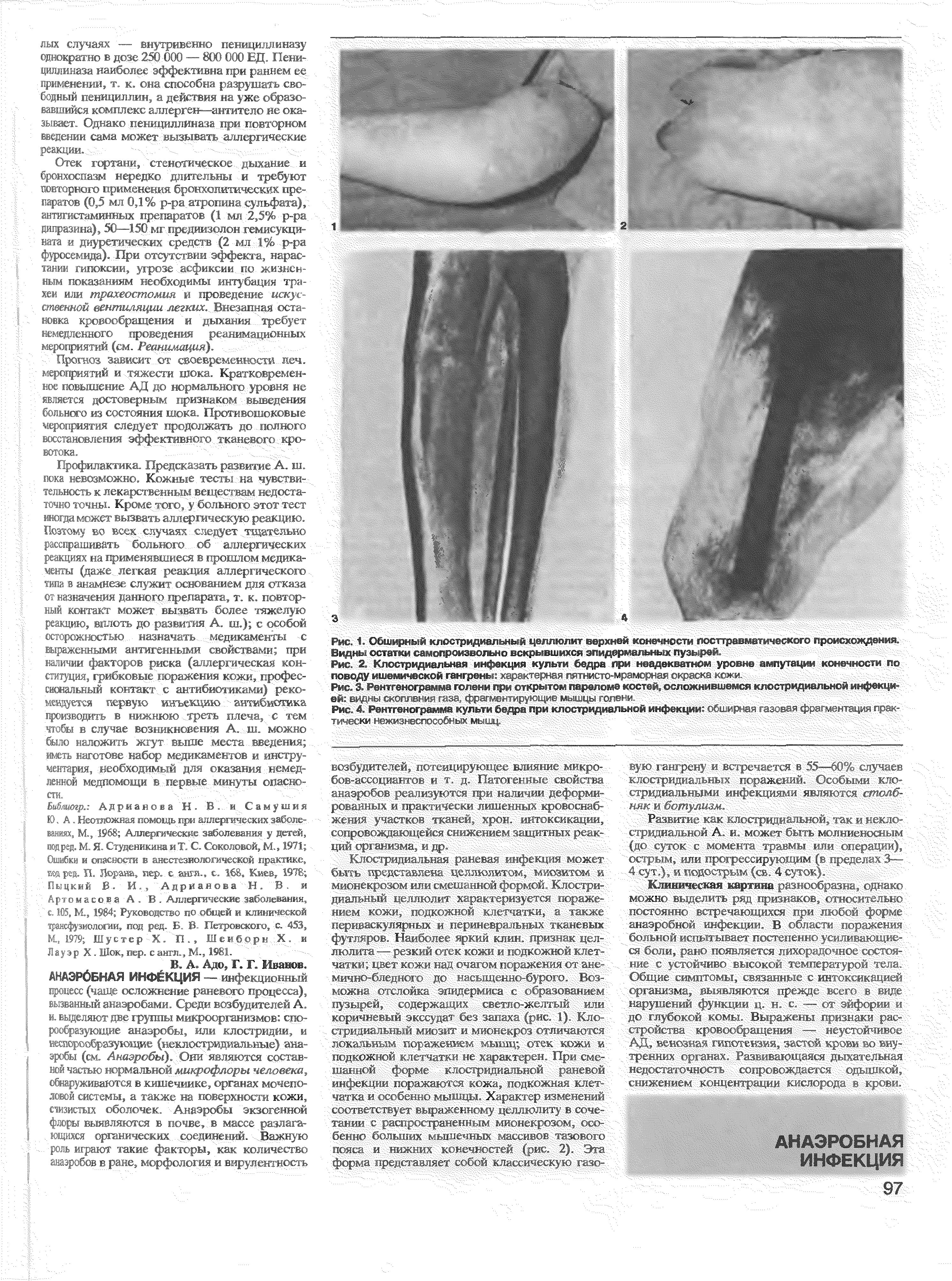 Рис. 4. Рентгенограмма культи бедра при клостридиальной инфекции г 6ш< т- ю <е< л < , 1 тически нежизнеспособных мышц.