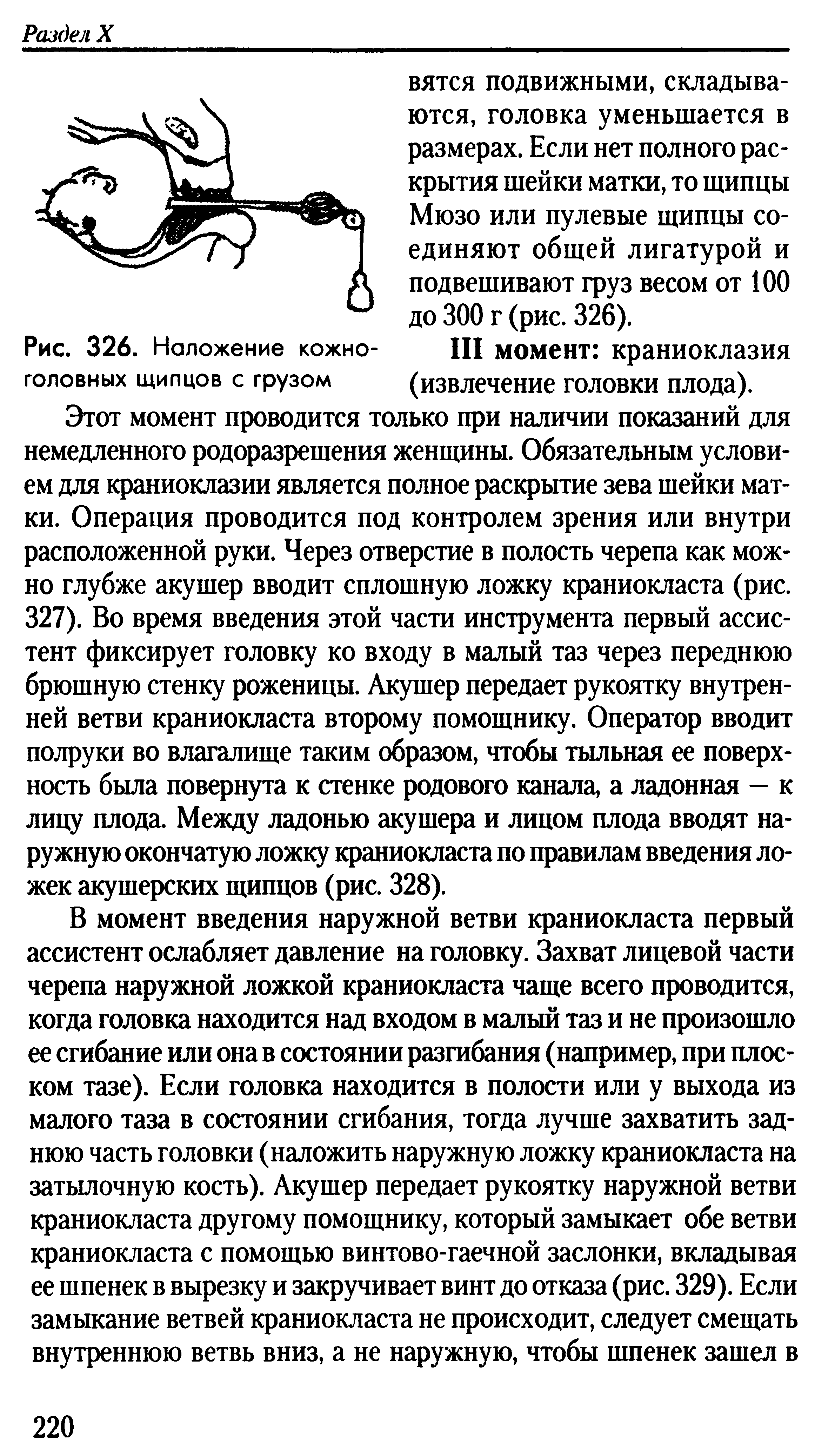 Рис. 326. Наложение кожно- III момент краниоклазия головных щипцов с грузом (извлечение головки плода).