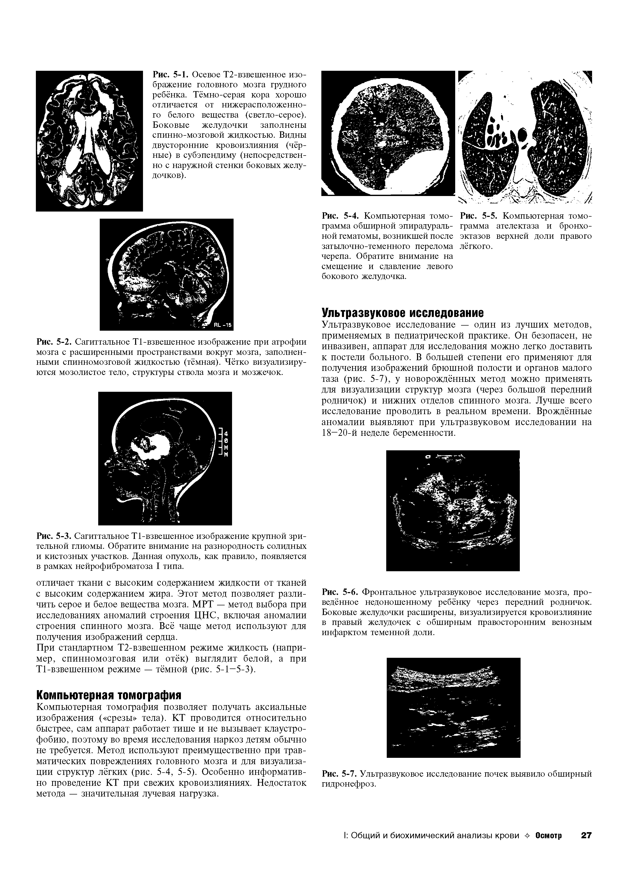 Рис. 5-6. Фронтальное ультразвуковое исследование мозга, проведённое недоношенному ребёнку через передний родничок. Боковые желудочки расширены, визуализируется кровоизлияние в правый желудочек с обширным правосторонним венозным инфарктом теменной доли.