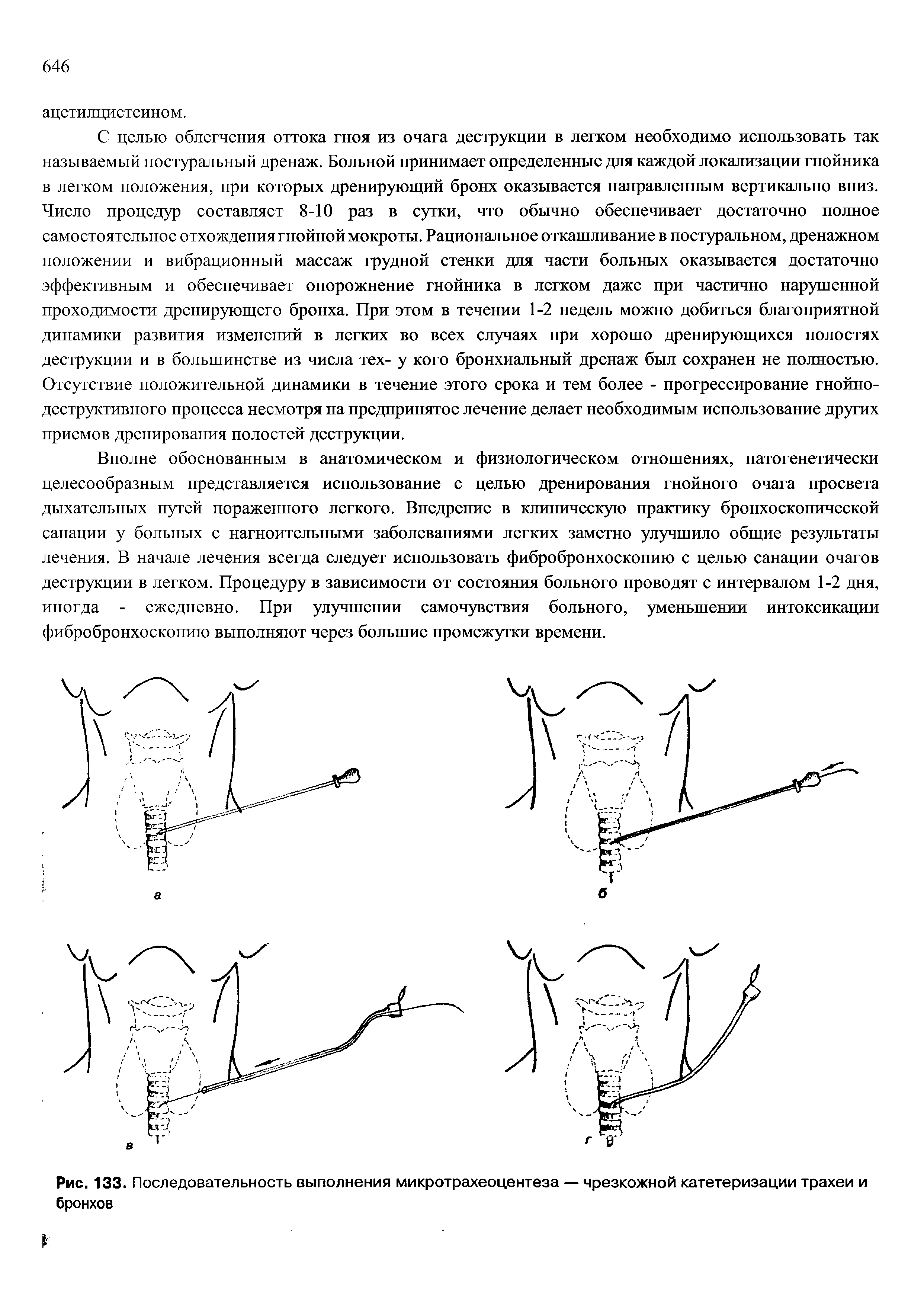 Рис. 133. Последовательность выполнения микротрахеоцентеза — чрезкожной катетеризации трахеи и бронхов...