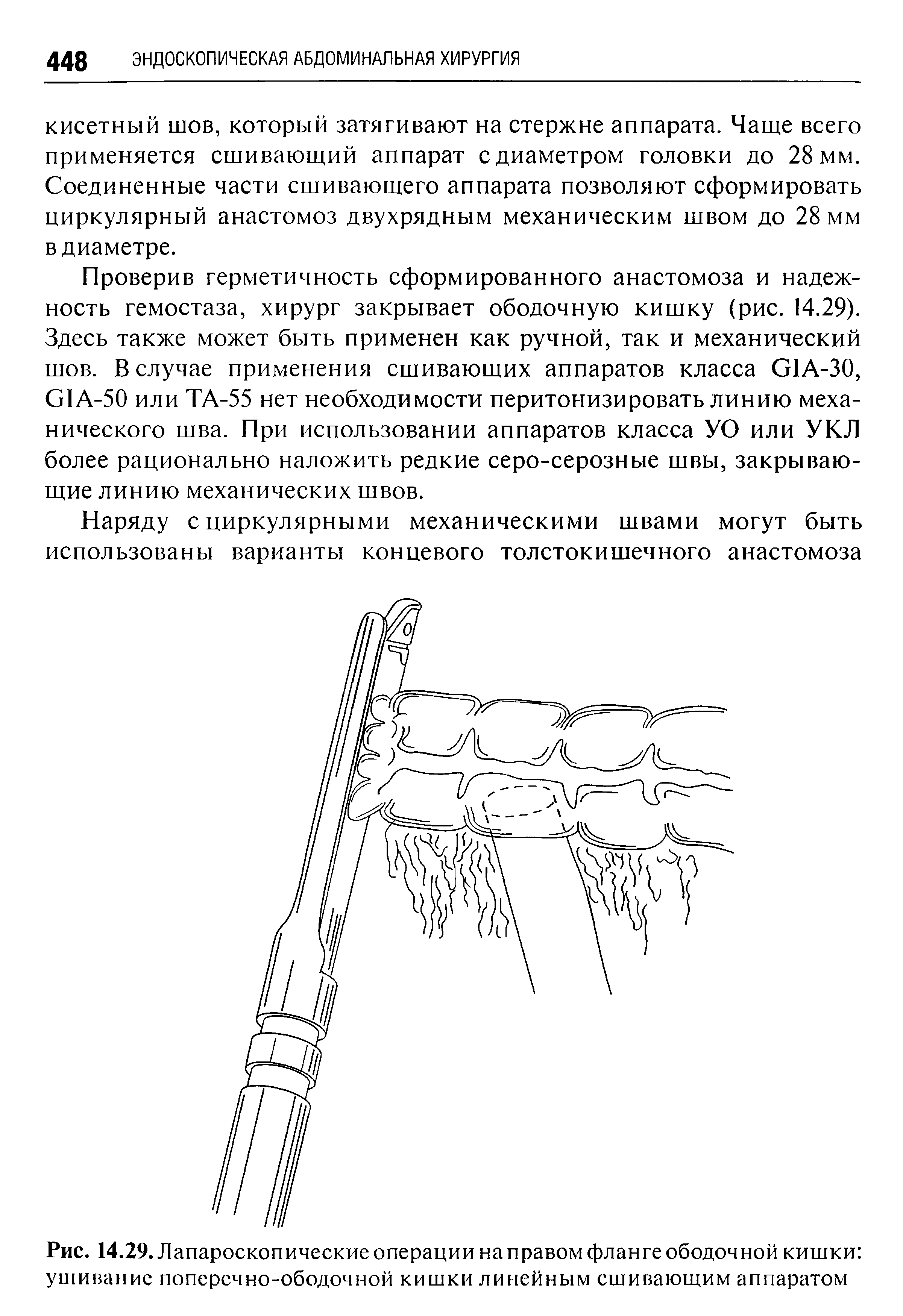 Рис. 14.29. Лапароскопические операции на правом фланге ободочной кишки ушивание поперечно-ободочной кишки линейным сшивающим аппаратом...