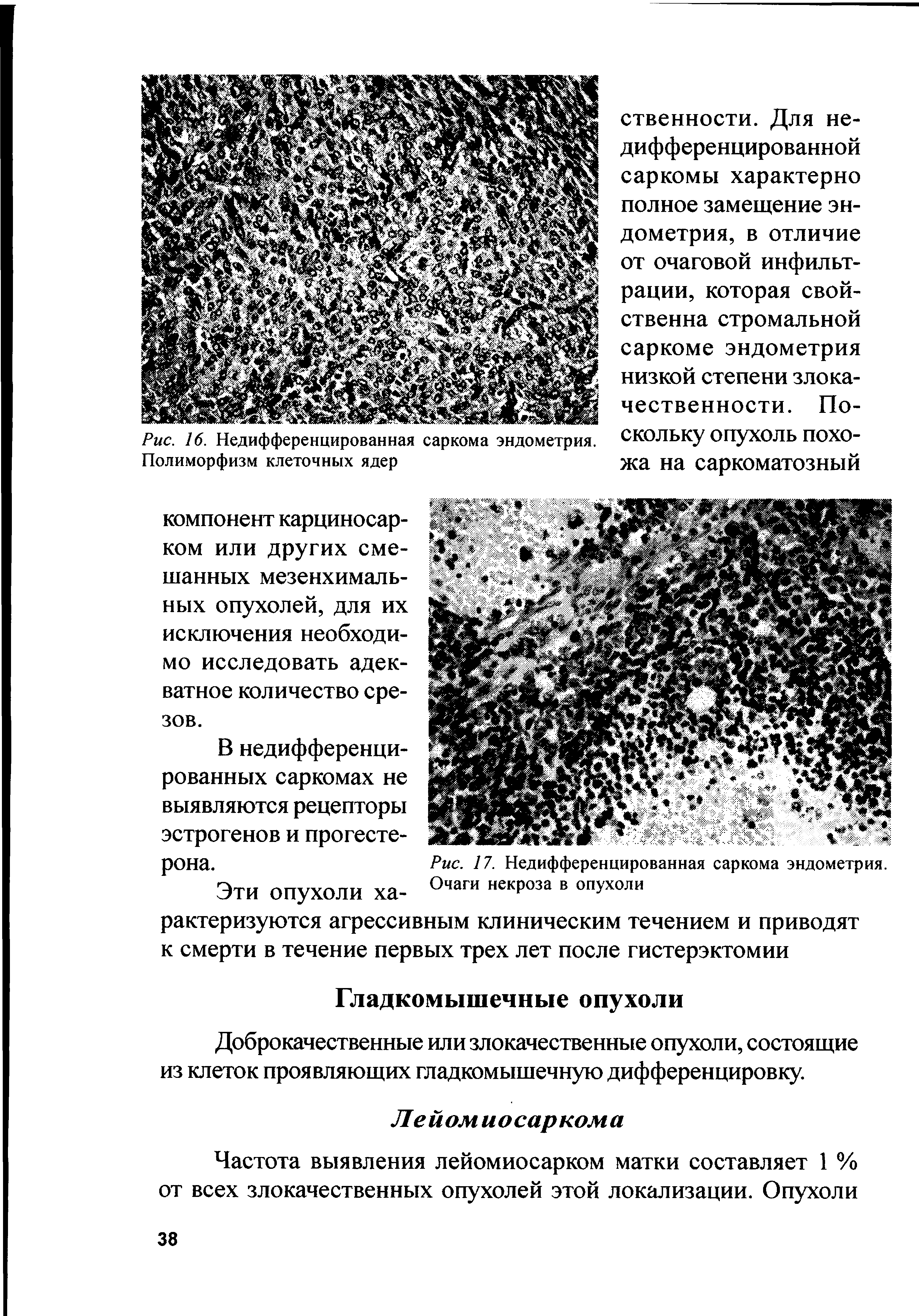 Рис. 17. Недифференцированная саркома эндометрия. Очаги некроза в опухоли...