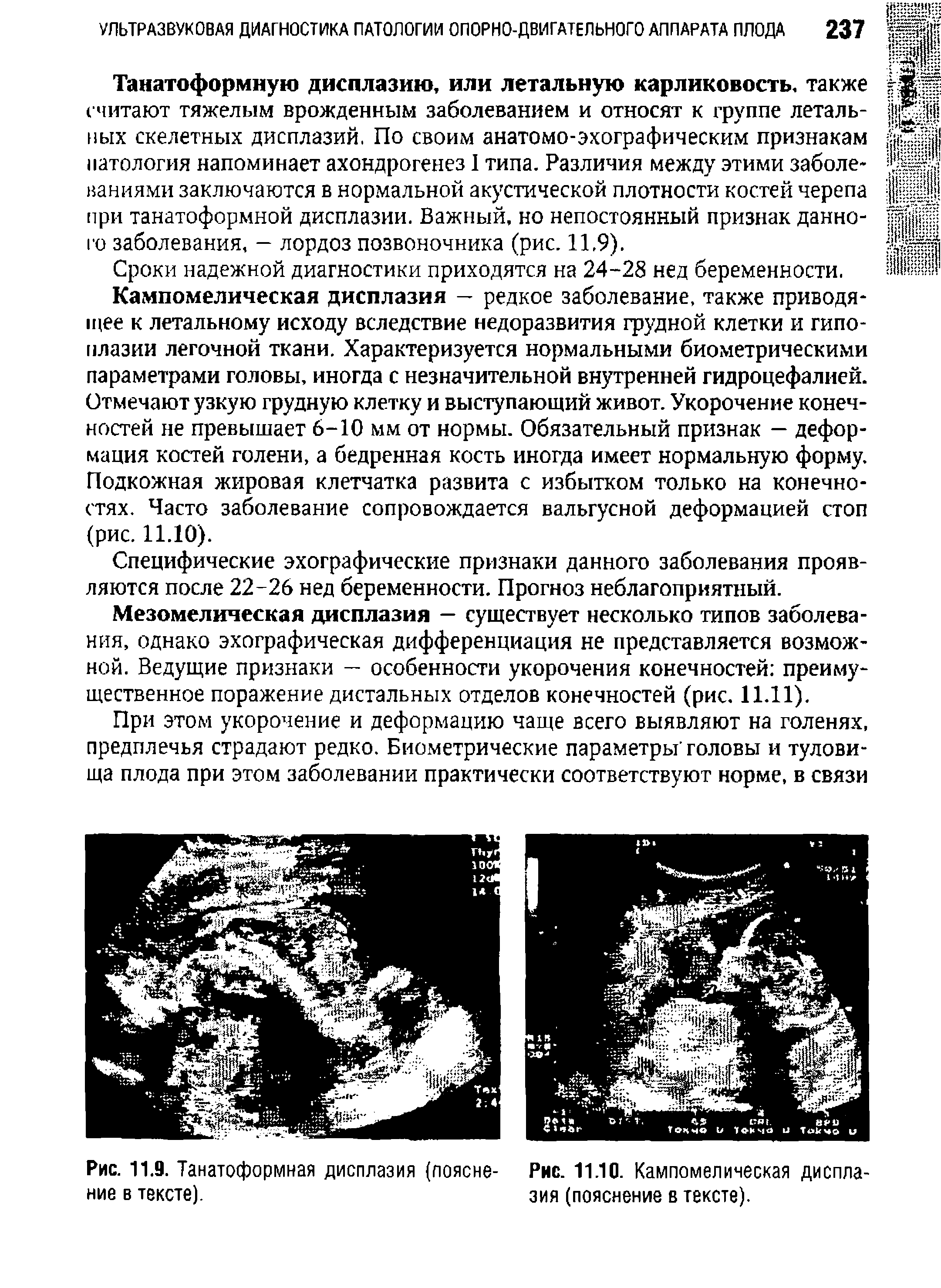 Рис. 11.9. Танатоформная дисплазия (поясне- Рис. 11.10. Кампомелическая диспла-ние в тексте). зия (пояснение в тексте).