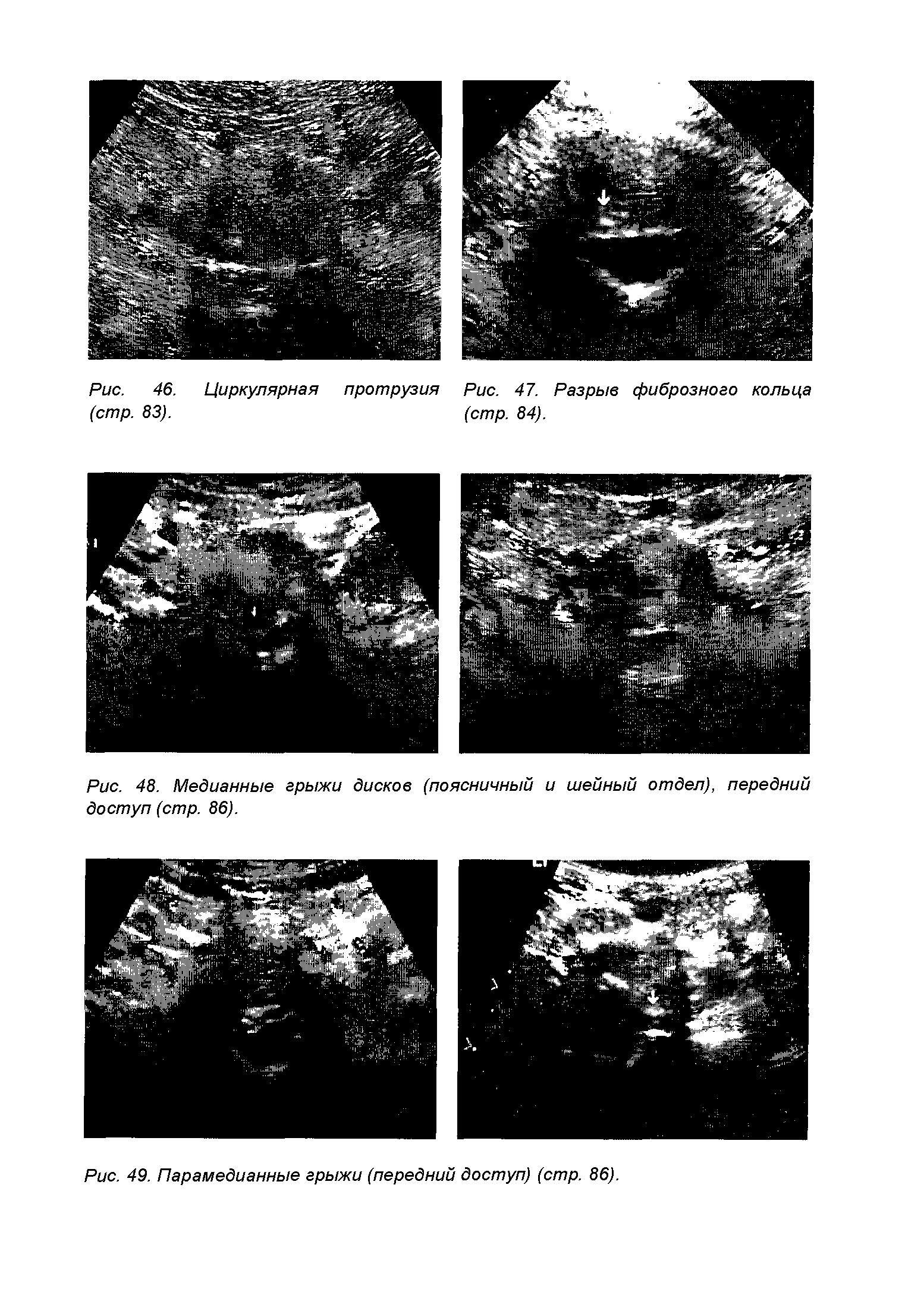 Рис. 48. Медианные грыжи дисков (поясничный и шейный отдел), передний доступ (стр. 86).