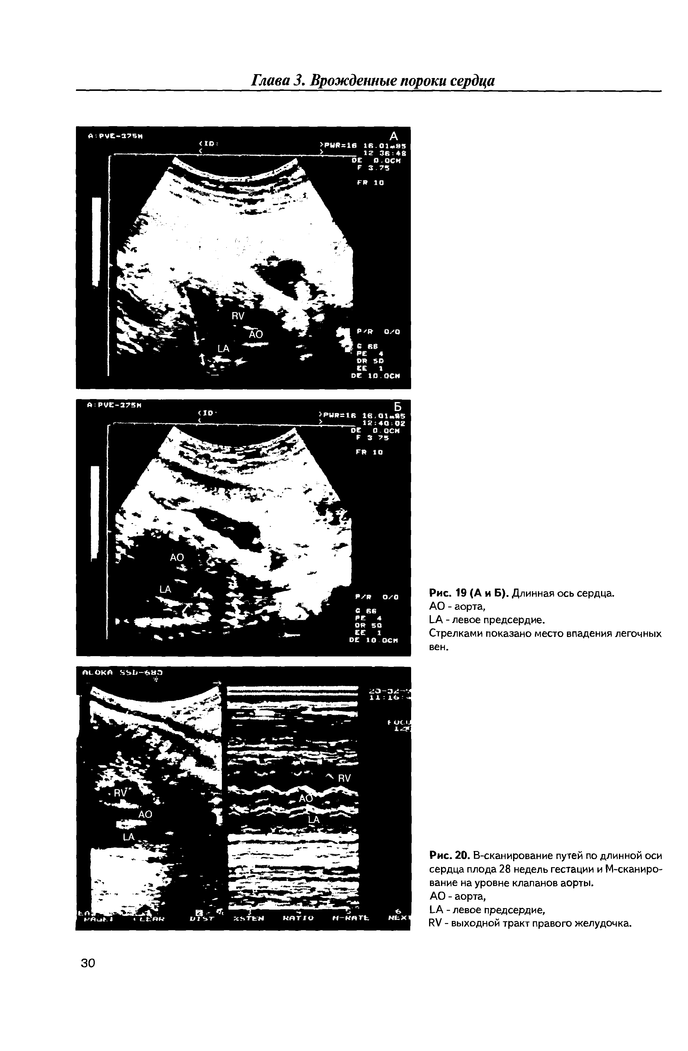 Рис. 20. В-сканирование путей по длинной оси сердца плода 28 недель гестации и М-сканиро-вание на уровне клапанов аорты.