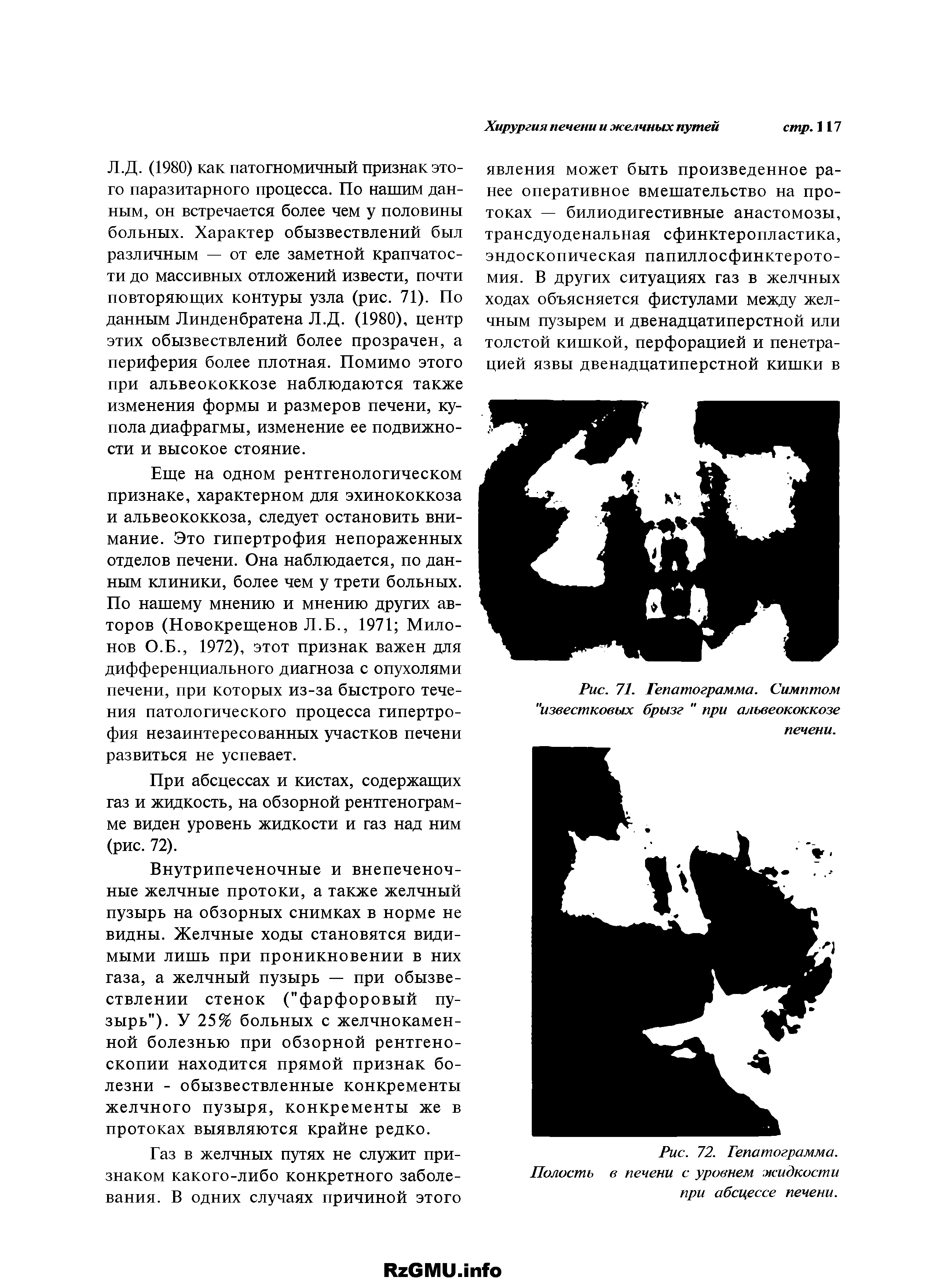 Рис. 71. Гепатограмма. Симптом "известковых брызг " при альвеококкозе печени.