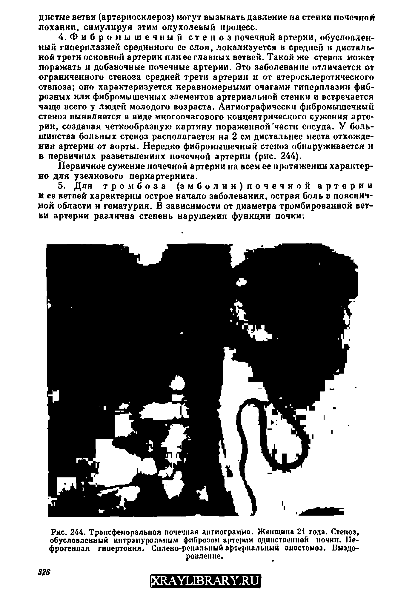 Рис. 244. Тронсфеморальная почечная ангиограмма. Женщина 21 года. Степоз, обусловленный интрамуральным фиброзом артерии единственной почки. Нефрогенная гипертония. Силено-ренальный артериальный анастомоз. Выздоровление.