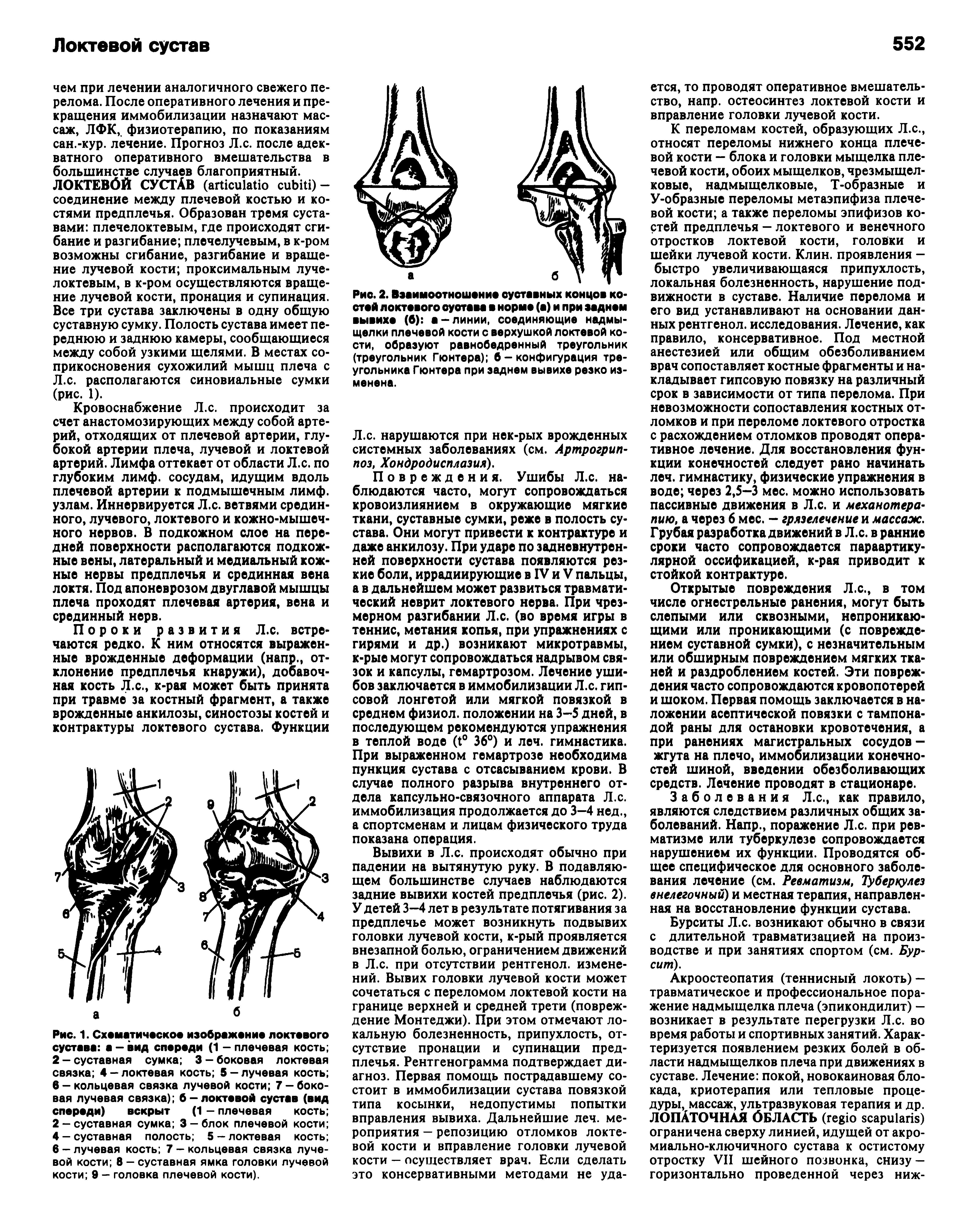 Рис. 2. Взаимоотношение суставных концов костей локтевого оуотава в норме (а) и при заднем вывихе (б) а-линии, соединяющие надмыщелки плечевой кости с верхушкой локтевой кости, образуют равнобедренный треугольник (треугольник Гюнтера) б - конфигурация треугольника Гюнтера при заднем вывихе резко изменена.