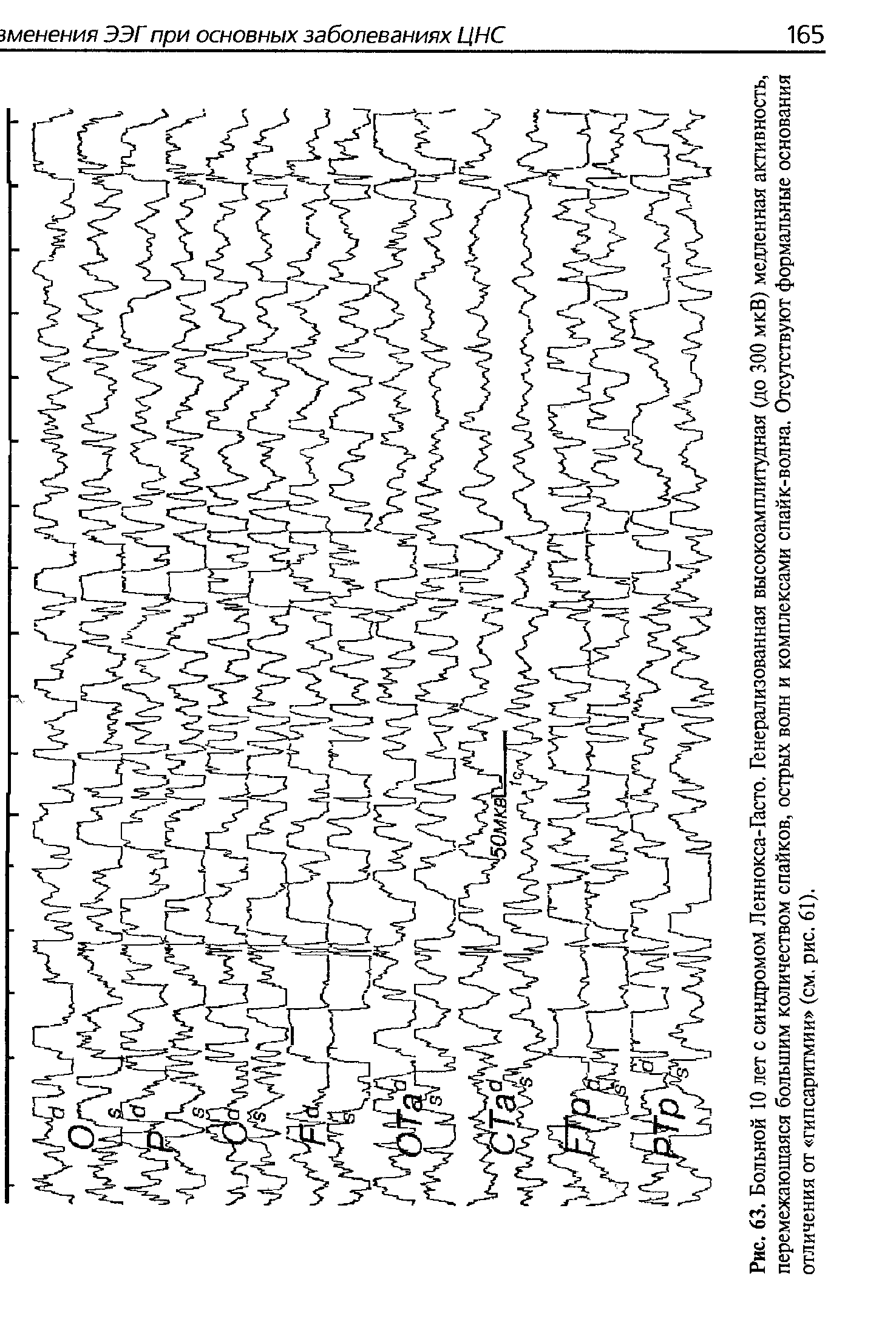 Рис. 63. Больной 10 лет с синдромом Леннокса-йсто. Генерализованная высокоамплитудная (до 300 мкВ) медленная активность, перемежающаяся большим количеством спайков, острых волн и комплексами спайк-волна. Отсутствуют формальные основания отличения от гипсаритмии (см. рис. 61).