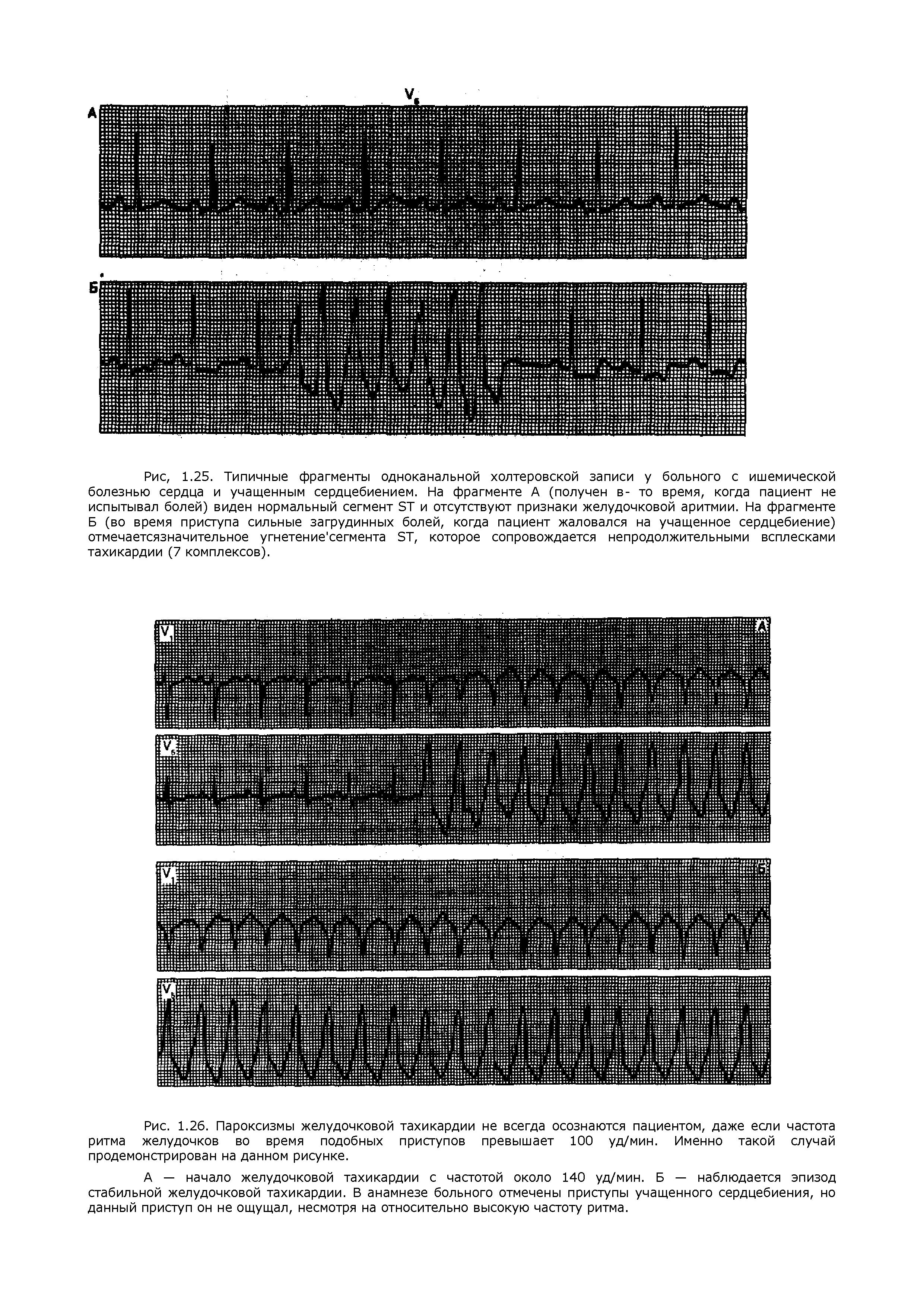Рис. 1.26. Пароксизмы желудочковой тахикардии не всегда осознаются пациентом, даже если частота ритма желудочков во время подобных приступов превышает 100 уд/мин. Именно такой случай продемонстрирован на данном рисунке.