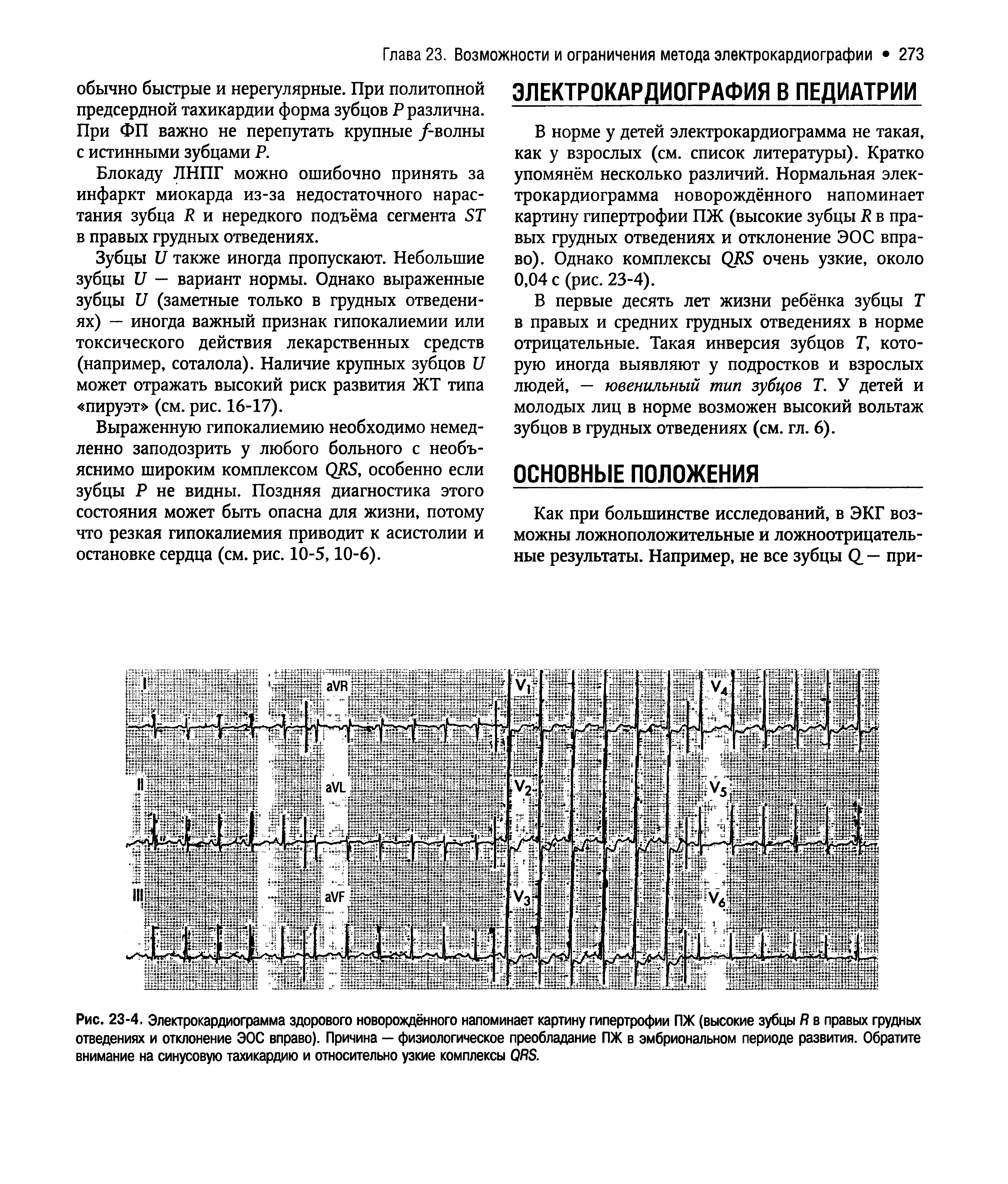 Рис. 23-4. Электрокардиограмма здорового новорождённого напоминает картину гипертрофии ПЖ (высокие зубцы Я в правых грудных отведениях и отклонение ЭОС вправо). Причина — физиологическое преобладание ПЖ в эмбриональном периоде развития. Обратите внимание на синусовую тахикардию и относительно узкие комплексы 0Я ...