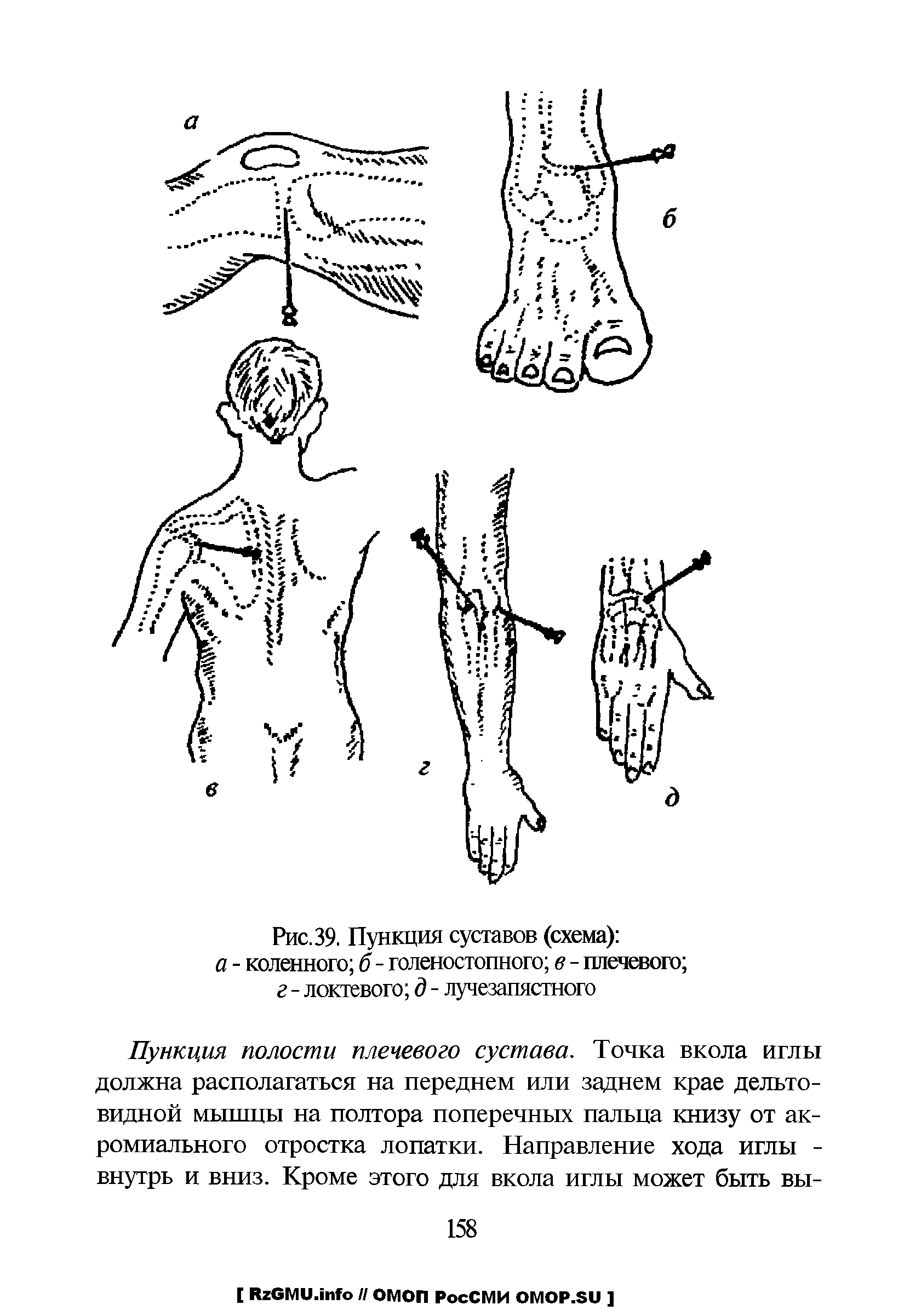 Рис. 39. Пункция суставов (схема) а - коленного б - голеностопного в - плечевого ...
