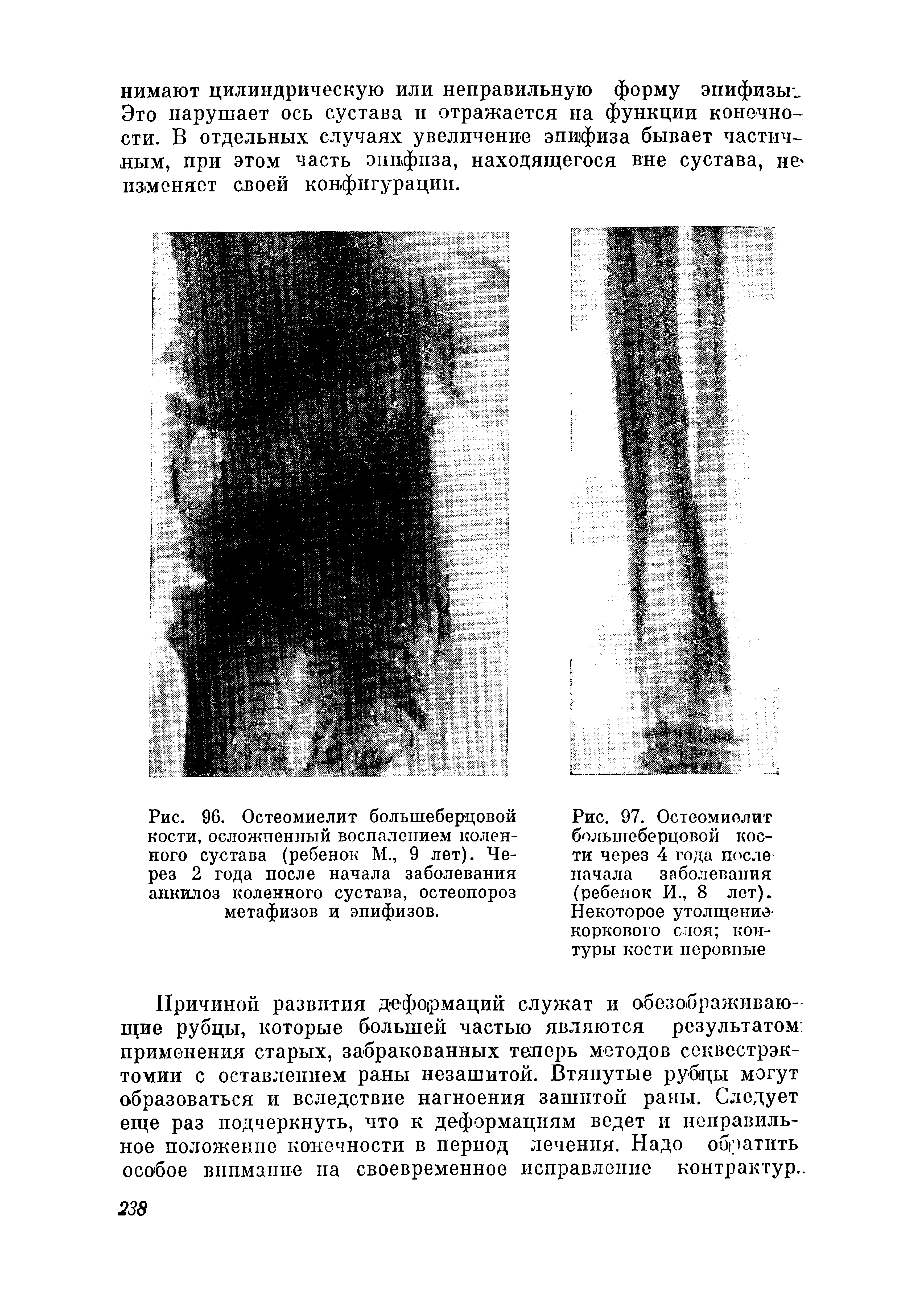 Рис. 96. Остеомиелит большеберцовой кости, осложненный воспалением коленного сустава (ребенок М., 9 лет). Через 2 года после начала заболевания анкилоз коленного сустава, остеопороз метафизов и эпифизов.