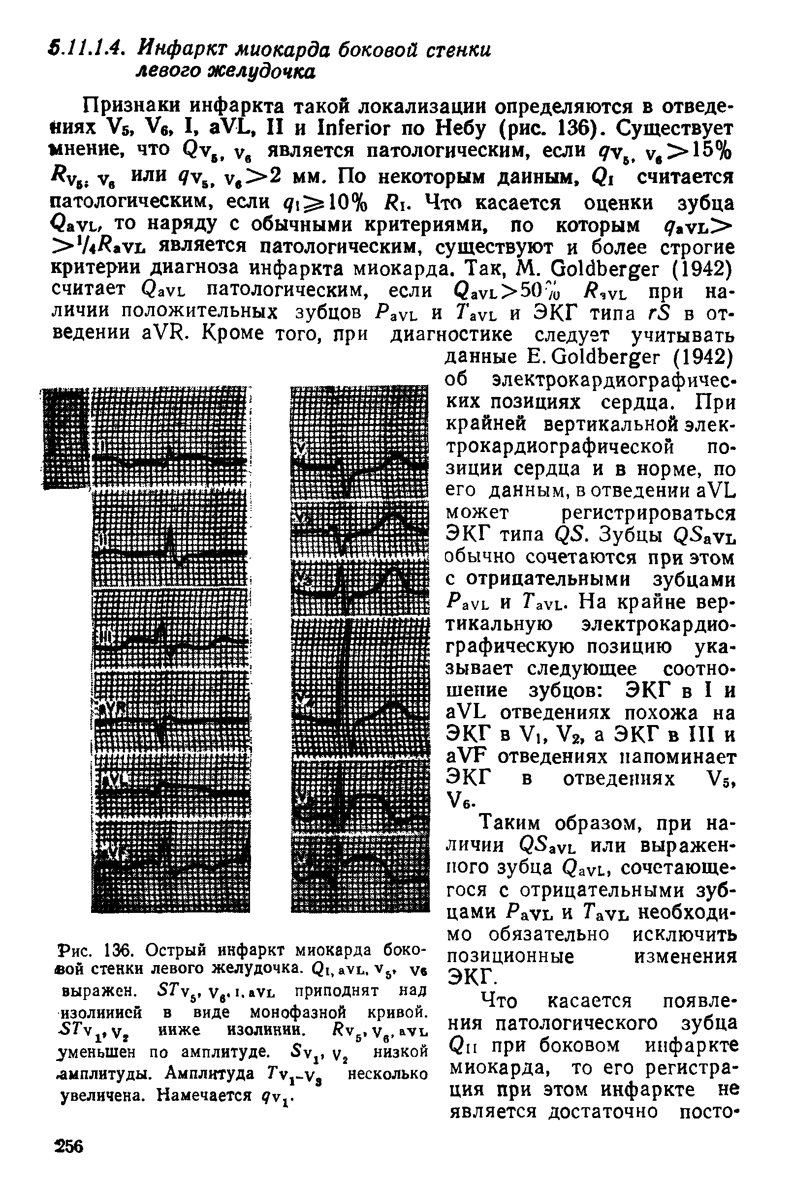 Рис. 136. Острый инфаркт миокарда боковой стенки левого желудочка. <2 ауь. у5, ув выражен. 57у5, ув. 1. ауь приподнят над изолинией в виде монофазной кривой. уг ниже изолинии. у5, ув, ауь уменьшен по амплитуде. 5у2, у2 низкой. амплитуды. Амплитуда Ту1 уа несколько увеличена. Намечается у1.