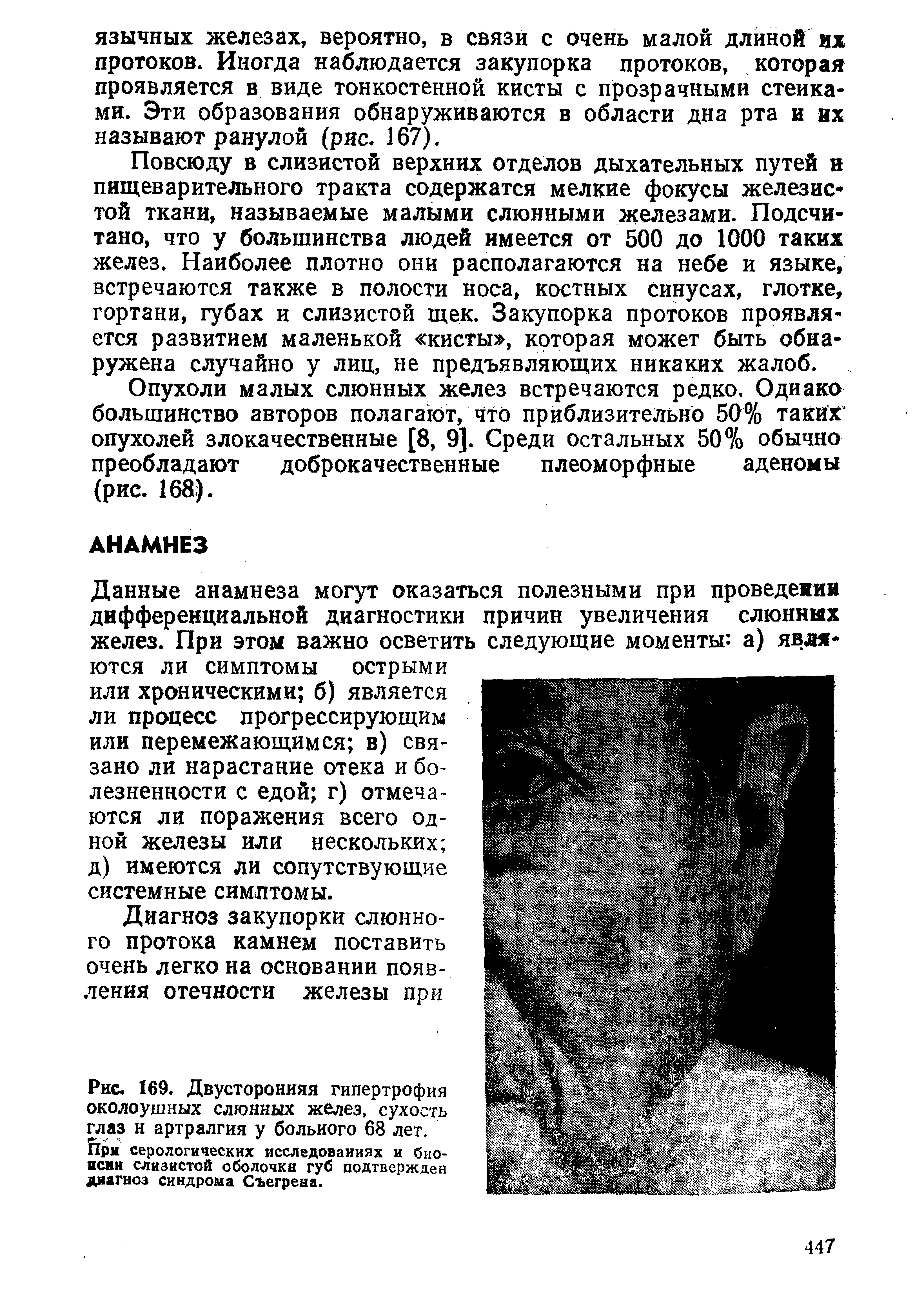 Рис. 169. Двусторонняя гипертрофия околоушных слюнных желез, сухость глаз н артралгия у больного 68 лет.