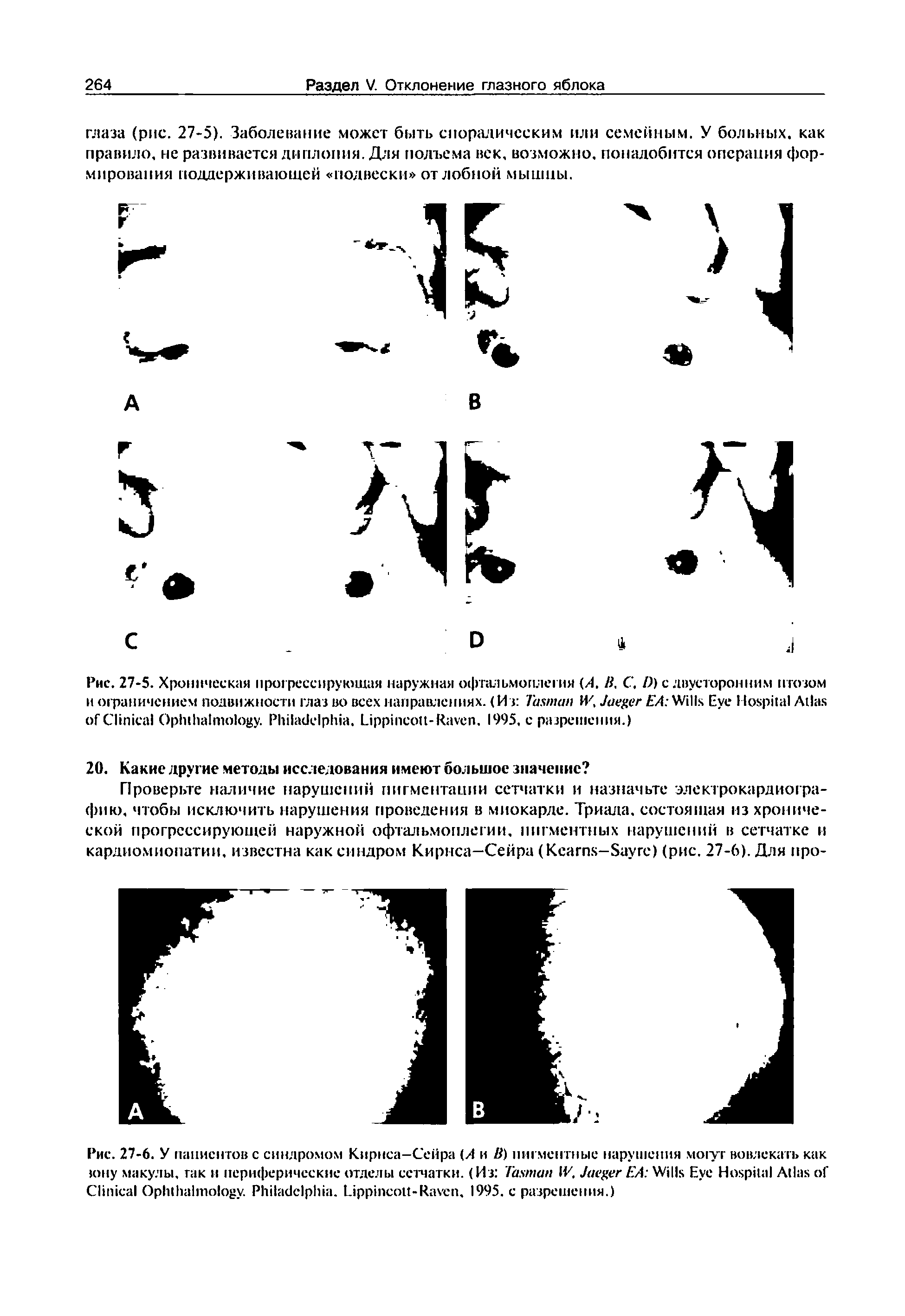 Рис. 27-5. Хроническая прогрессирующая наружная офтальмоплегия (А, , С. D) с двусторонним птозом и ограничением подвижности глаз во всех направлениях. (Из T И7, J ЕА W E H A C O . P , L -R . 1995, с разрешения.)...