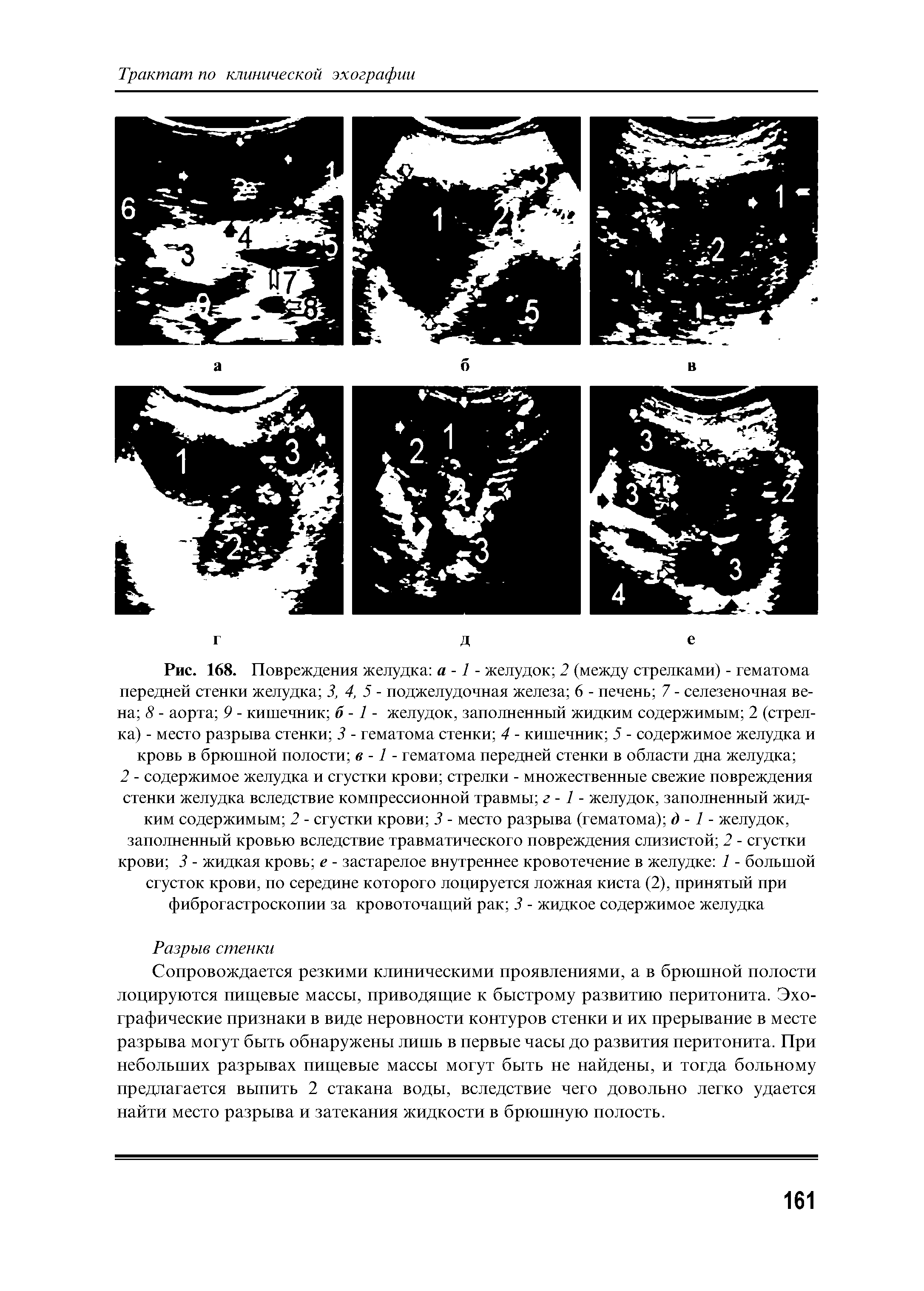 Рис. 168. Повреждения желудка а -1 - желудок 2 (между стрелками) - гематома передней стенки желудка 3, 4, 5 - поджелудочная железа 6 - печень 7 - селезеночная вена 8 - аорта 9 - кишечник б -1 - желудок, заполненный жидким содержимым 2 (стрелка) - место разрыва стенки 3 - гематома стенки 4 - кишечник 5 - содержимое желудка и кровь в брюшной полости в -1 - гематома передней стенки в области дна желудка ...