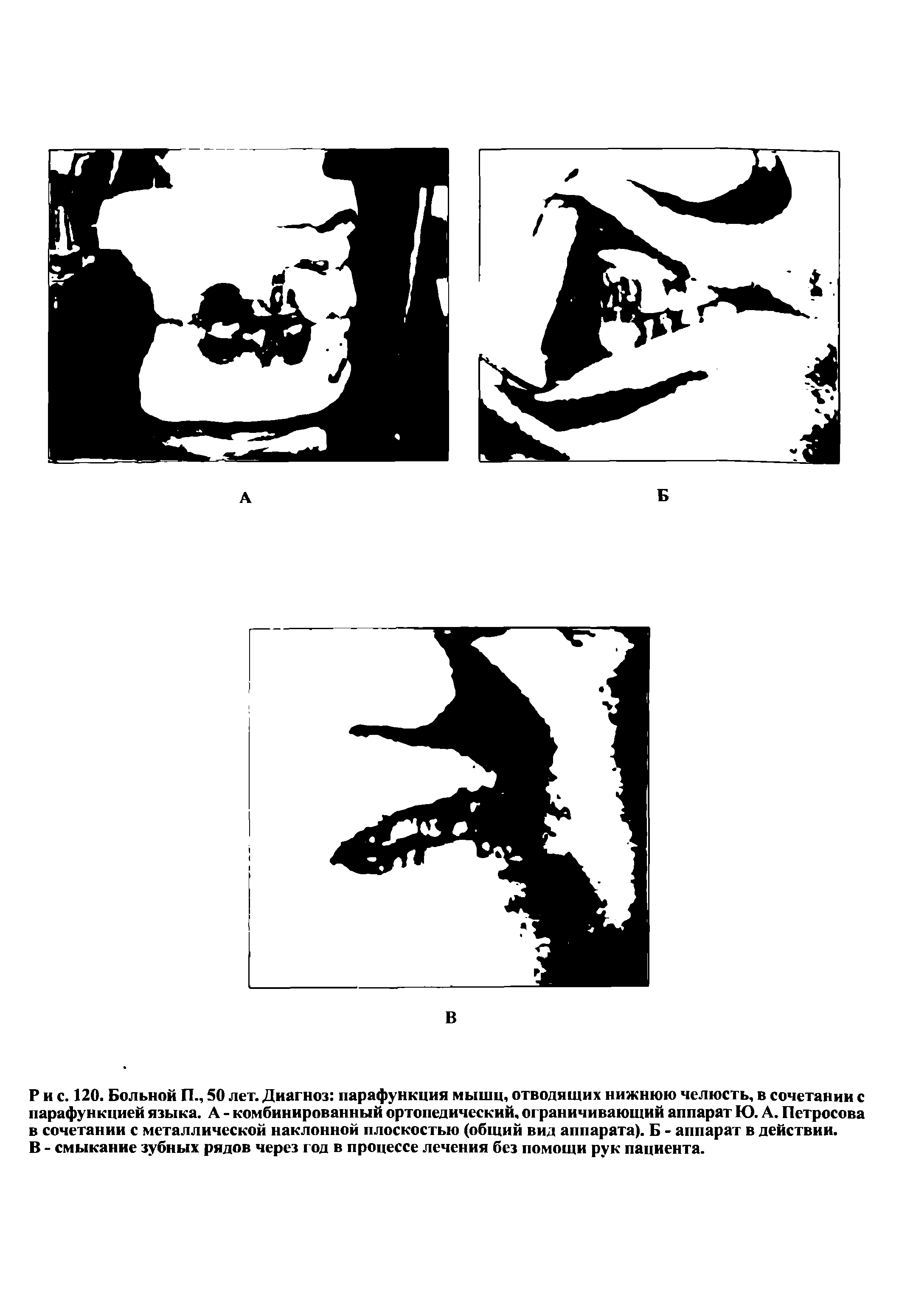 Рис. 120. Больной П., 50 лет. Диагноз парафункция мышц, отводящих нижнюю челюсть, в сочетании с парафункцией языка. А - комбинированный ортопедический, ограничивающий аппарат Ю. А. Петросова в сочетании с металлической наклонной плоскостью (общий вид аппарата). Б - аппарат в действии. В - смыкание зубных рядов через год в процессе лечения без помощи рук пациента.