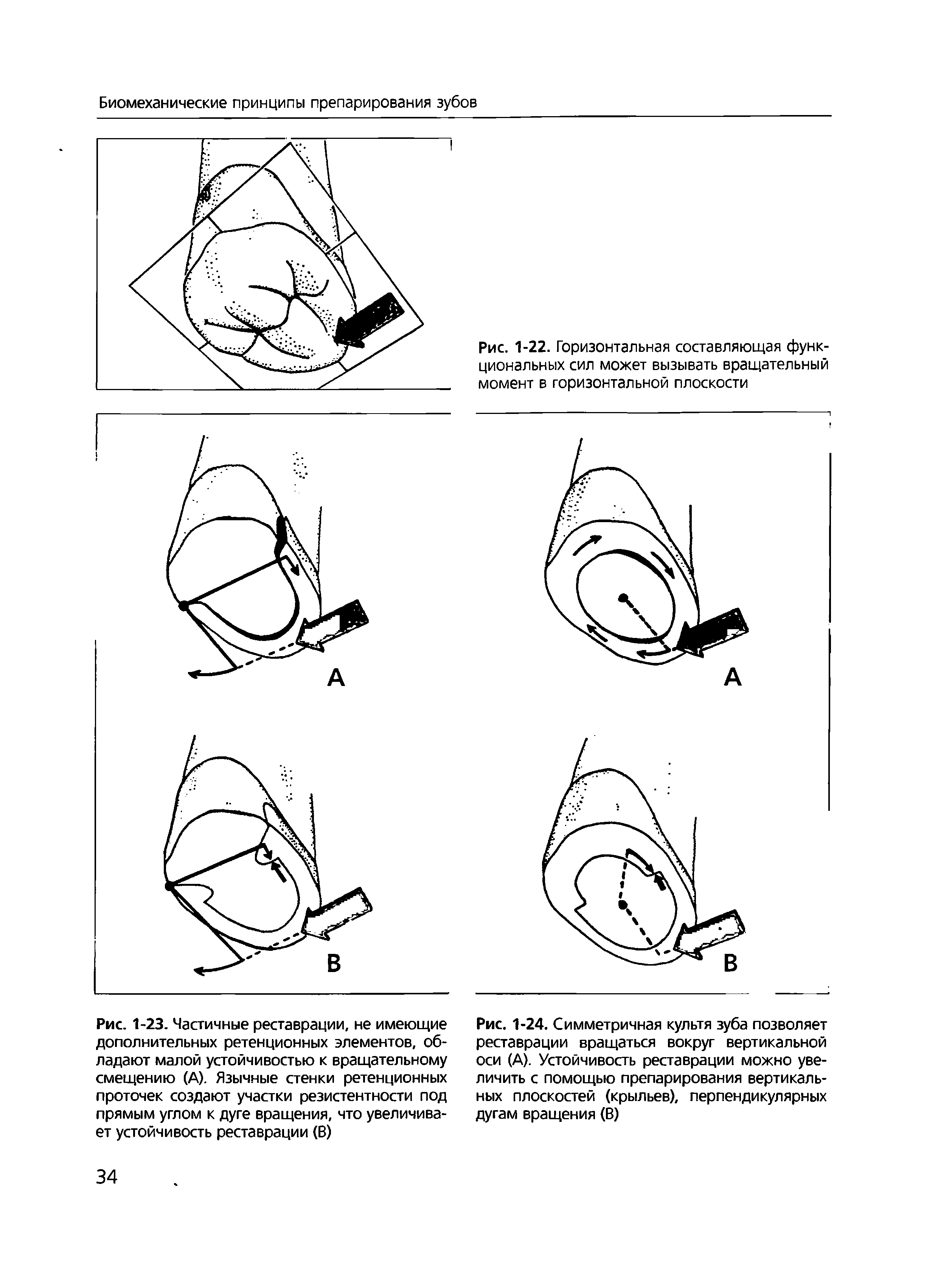 Рис. 1-24. Симметричная культя зуба позволяет реставрации вращаться вокруг вертикальной оси (А). Устойчивость реставрации можно увеличить с помощью препарирования вертикальных плоскостей (крыльев), перпендикулярных дугам вращения (В)...