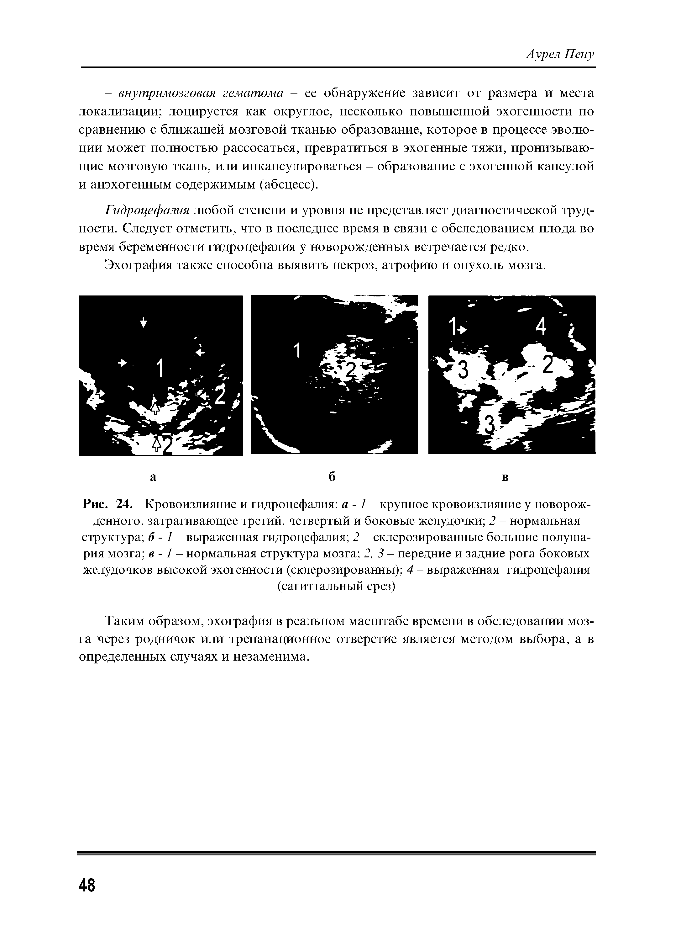 Рис. 24. Кровоизлияние и гидроцефалия а - 1 крупное кровоизлияние у новорожденного, затрагивающее третий, четвертый и боковые желудочки 2 - нормальная структура б - 1 - выраженная гидроцефалия 2 - склерозированные большие полушария мозга в -1 - нормальная структура мозга 2, 3 - передние и задние рога боковых желудочков высокой эхогенности (склерозированны) 4 - выраженная гидроцефалия (сагиттальный срез)...
