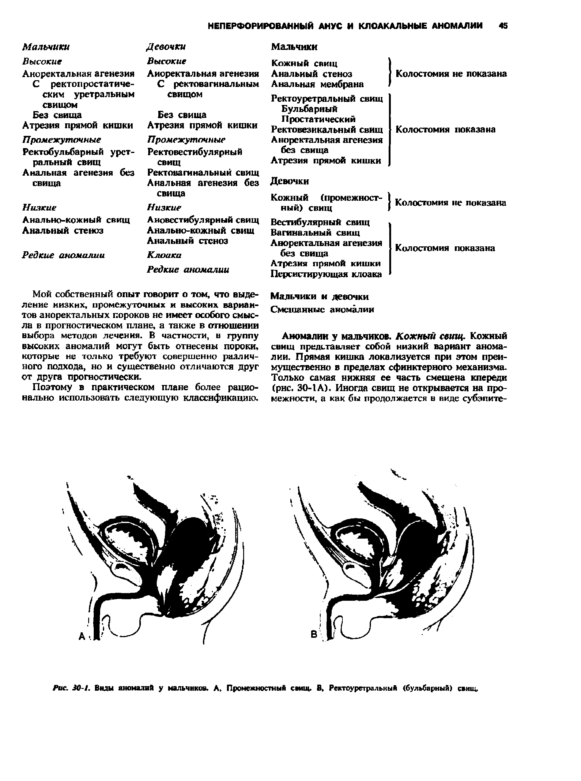 Рис. 30-1. Виды аноиалвй у мальчиков. А. Промежностный свищ. В, Ректоуретральный (бульбарный) свищ.