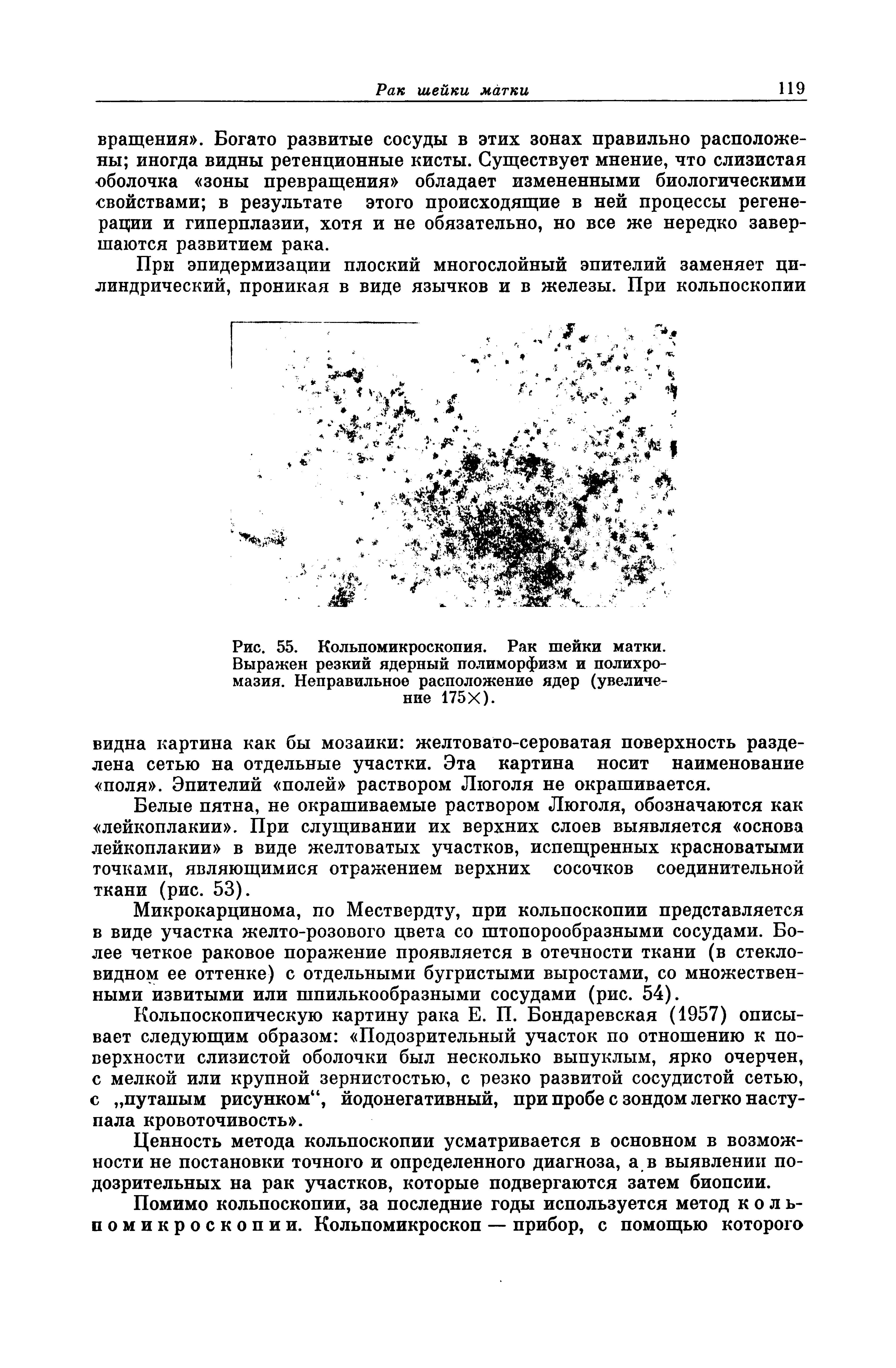 Рис. 55. Кольпомикроскопия. Рак шейки матки. Выражен резкий ядерный полиморфизм и полихромазия. Неправильное расположение ядер (увеличение 175Х).