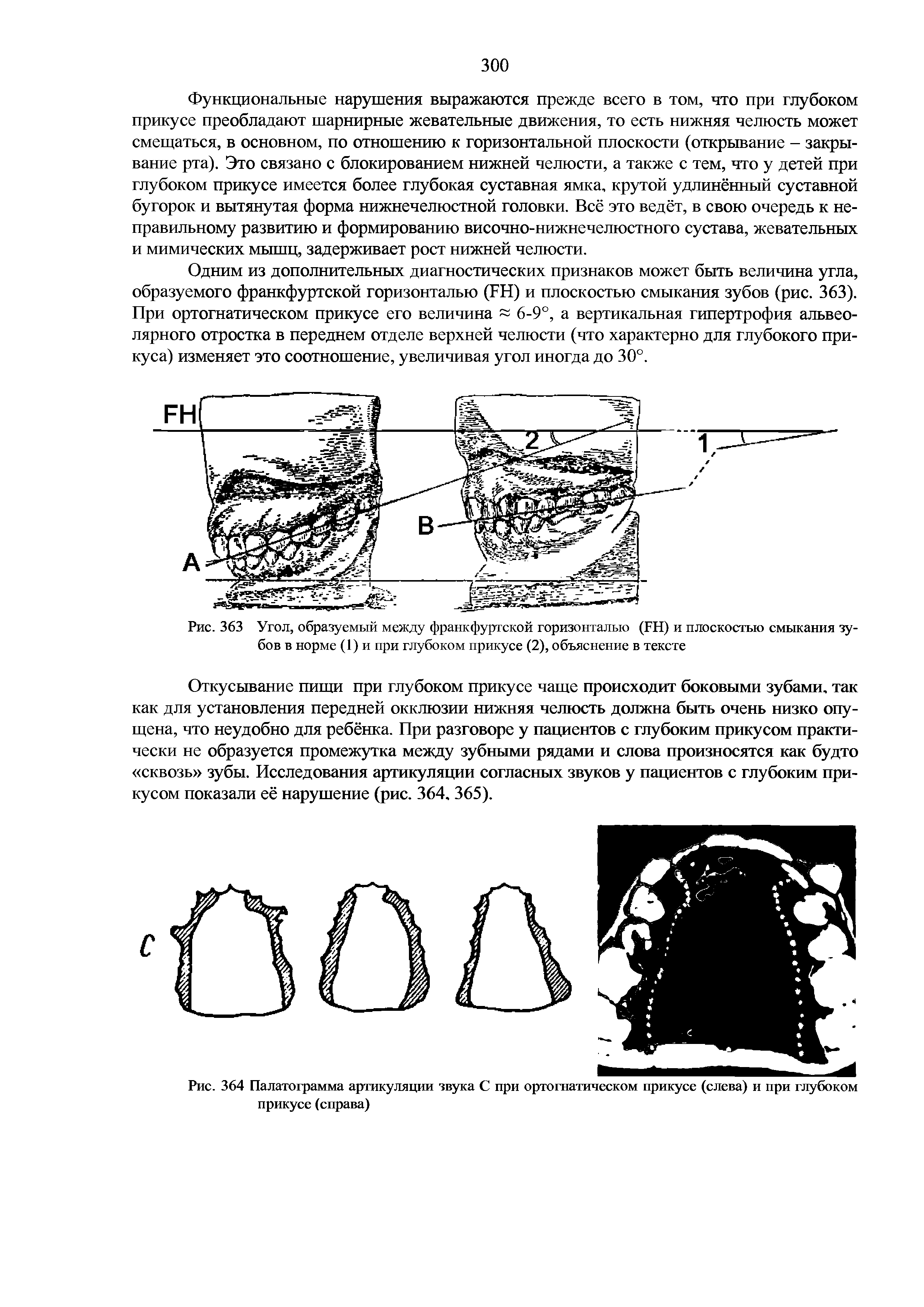 Рис. 363 Угол, образуемый между франкфуртской горизонталью (БН) и плоскостью смыкания зубов в норме (1) и при глубоком прикусе (2), объяснение в тексте...